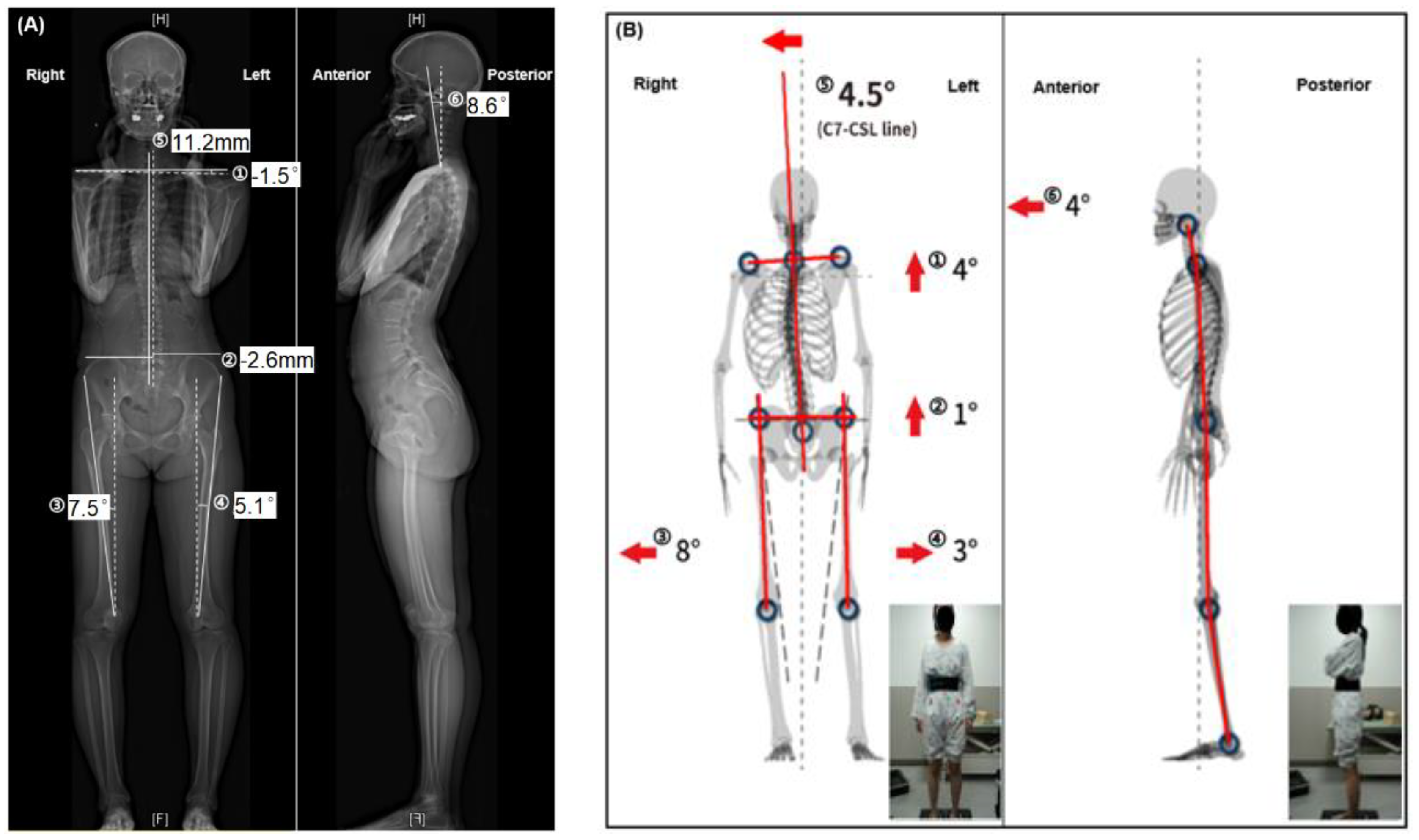 Postural assessment using whole-body EOS® system in the standing