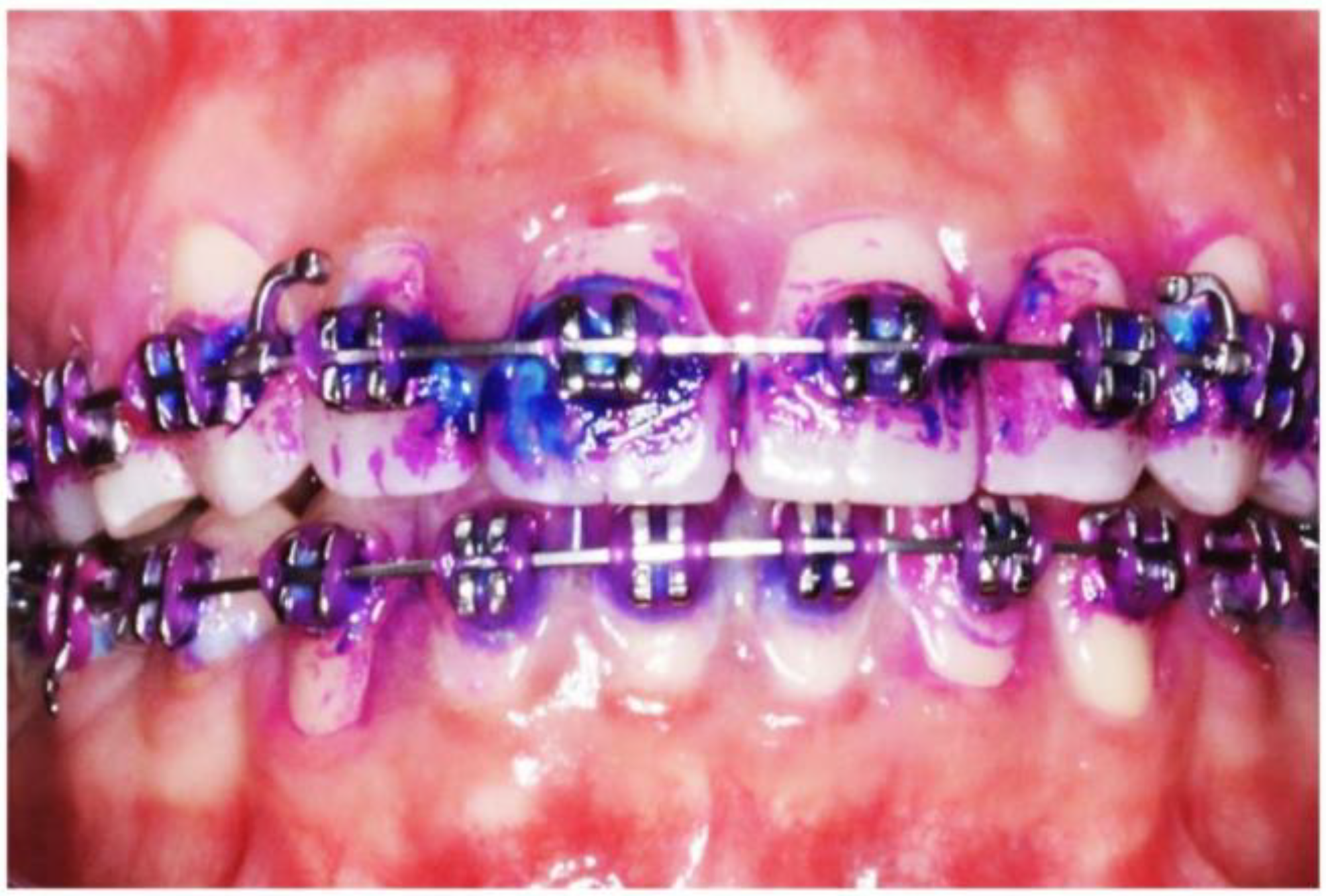 purple and teal braces
