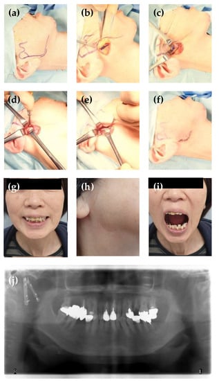 Facial Nerve Injury Following TMJ Surgery and its Management by