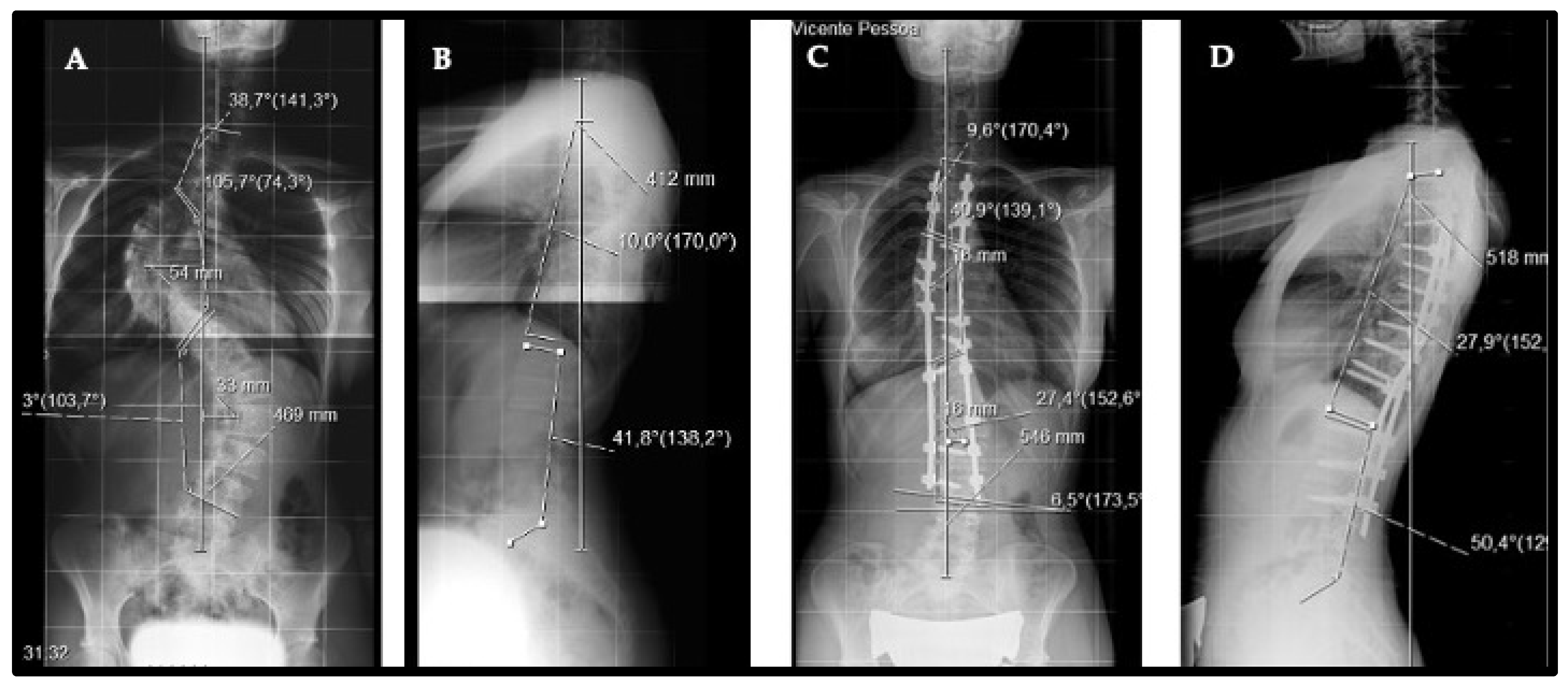 Healthcare | Free Full-Text | Benefits of Best Practice Guidelines in Spine  Fusion: Comparable Correction in AIS with Higher Density and Fewer  Complications