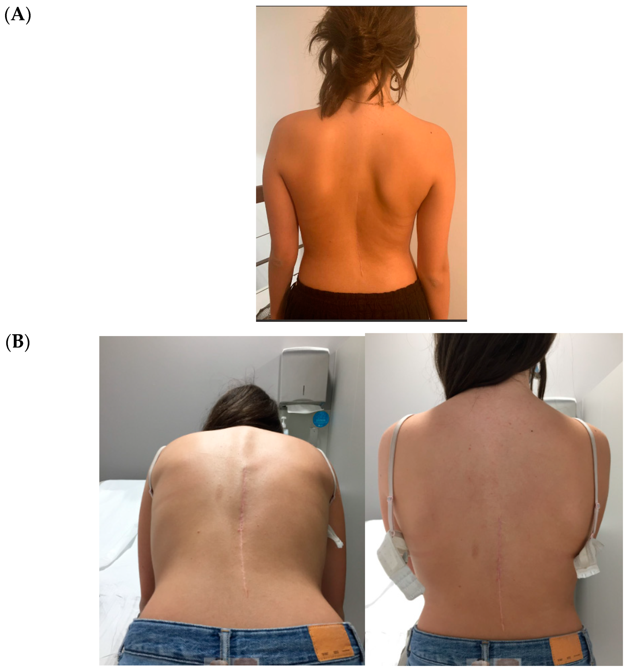 Scoliosis Rib Hump Results - Scoliosis Care Centers