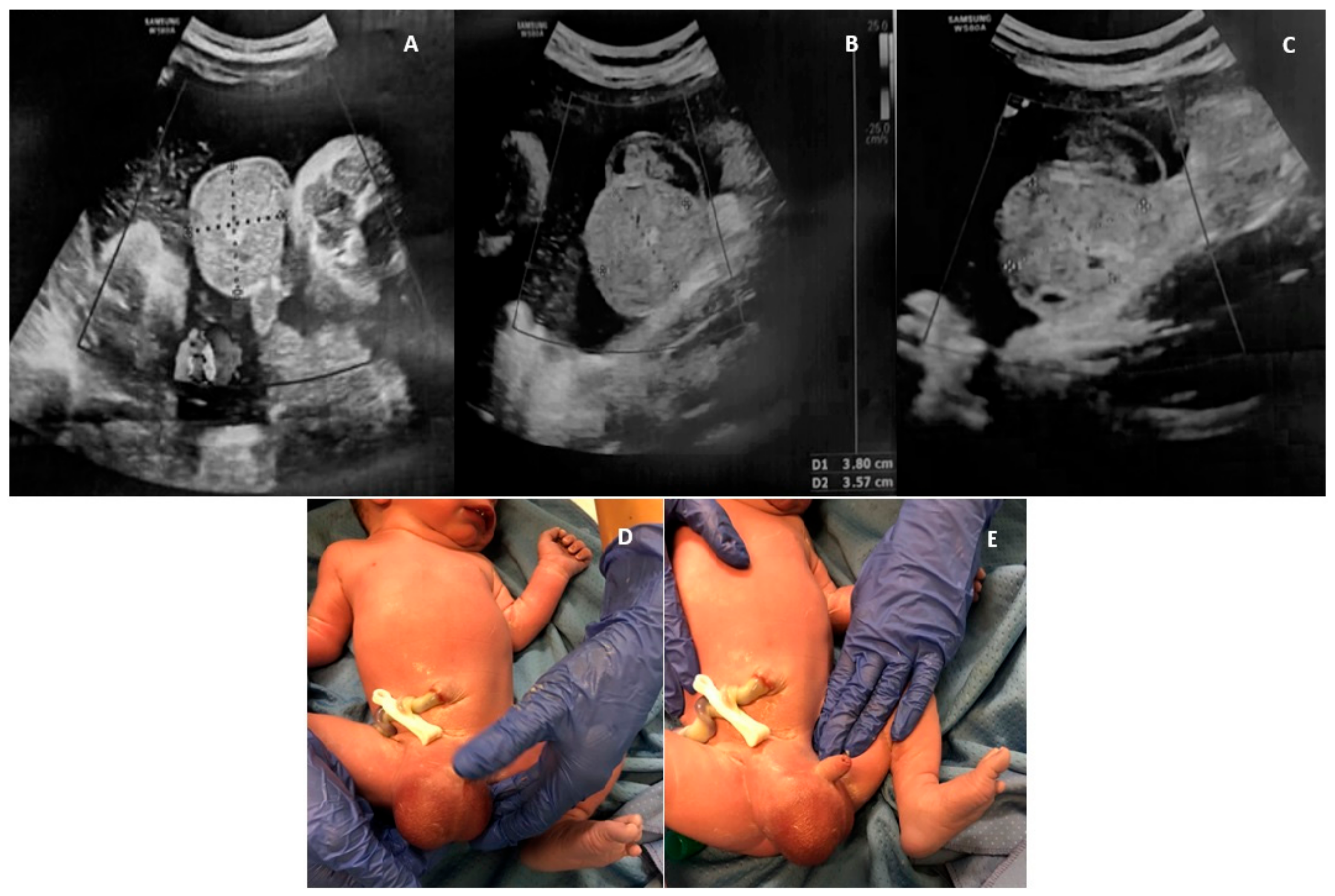 Healthcare | Free Full-Text | Inguinoscrotal Hernia, a Possible Cause of  Rapidly Developing Fetal Scrotal Mass: Case Report and Literature Update