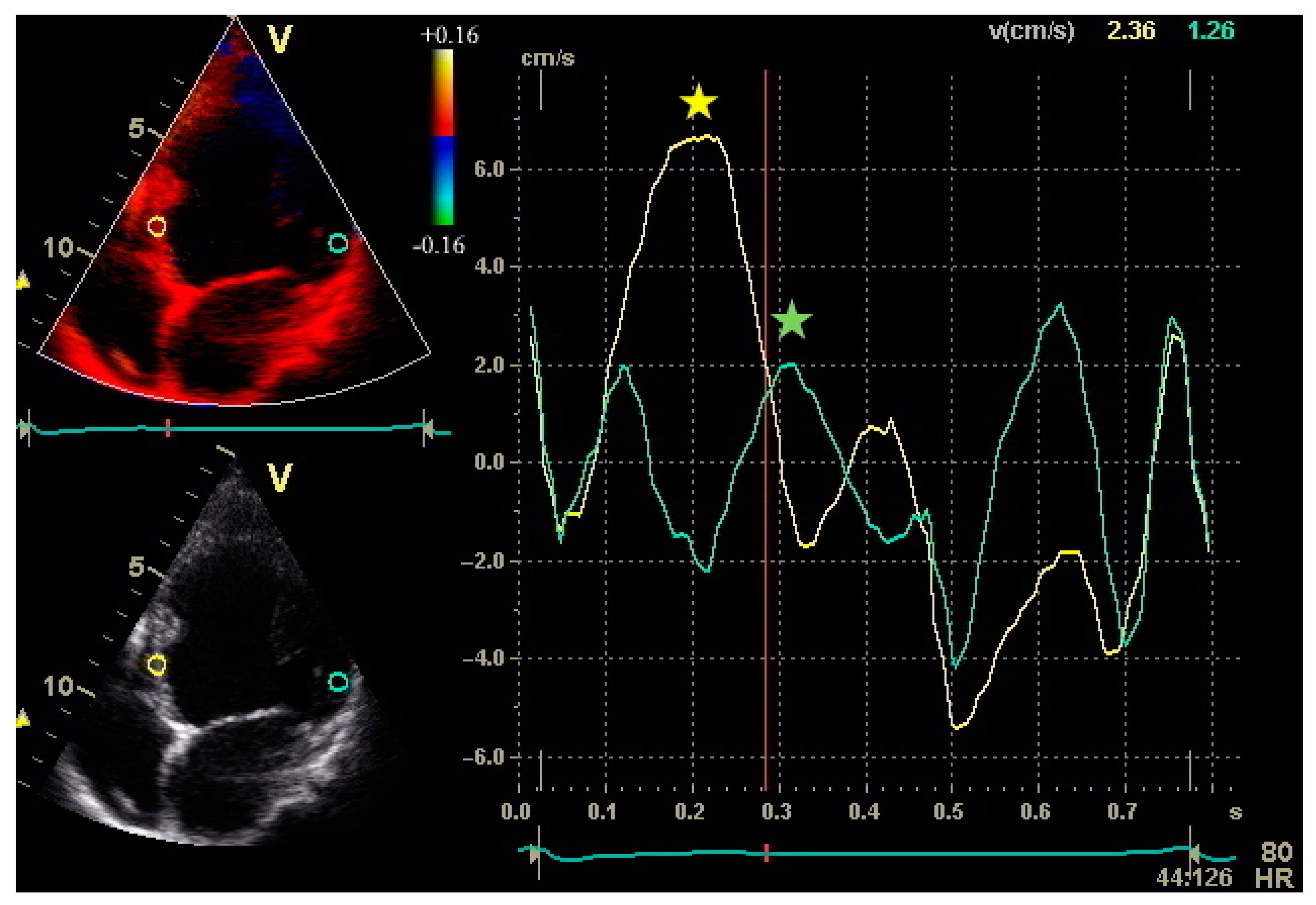 Hearts | Free Full-Text | Cardiovascular Imaging Applications in Clinical  Management of Patients Treated with Cardiac Resynchronization Therapy
