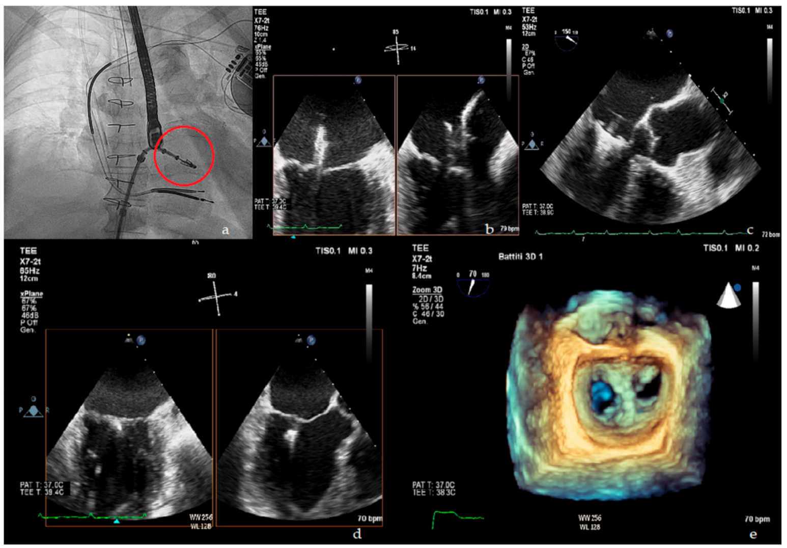 Hearts | Free Full-Text | Percutaneous Mitral Valve Repair with the  MitraClip System in the Current Clinical Practice