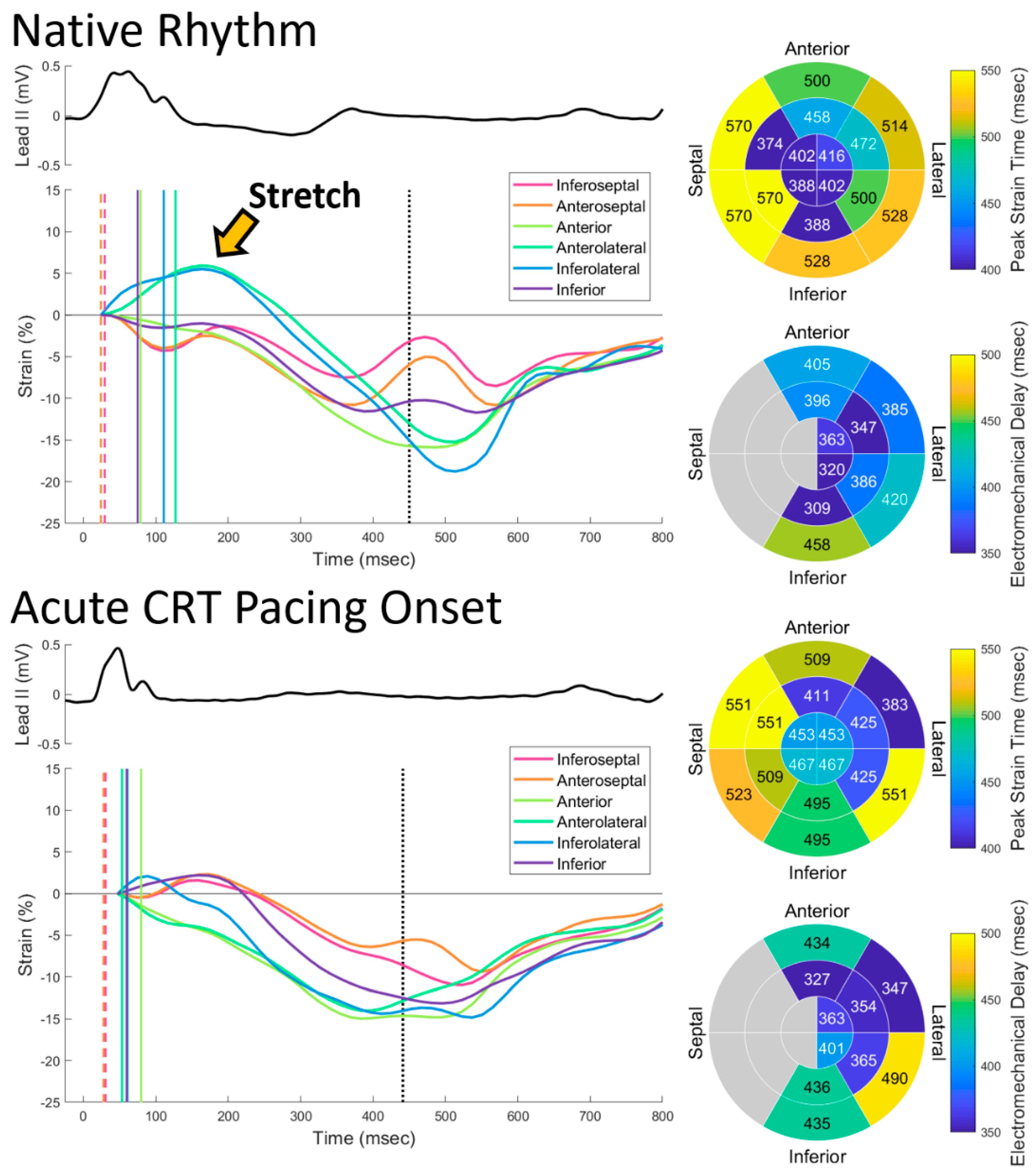 Speckle tracking strain and ECG heterogeneity correlate in transcatheter  aortic valve replacement-induced left bundle branch blocks and right  ventricular paced rhythms