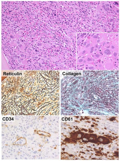 Hemato Free Full Text Whats New In The Classification Diagnosis