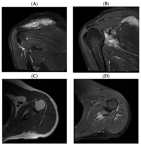 Hematology Reports | Free Full-Text | Primary Bone Lymphoma of the Scapula