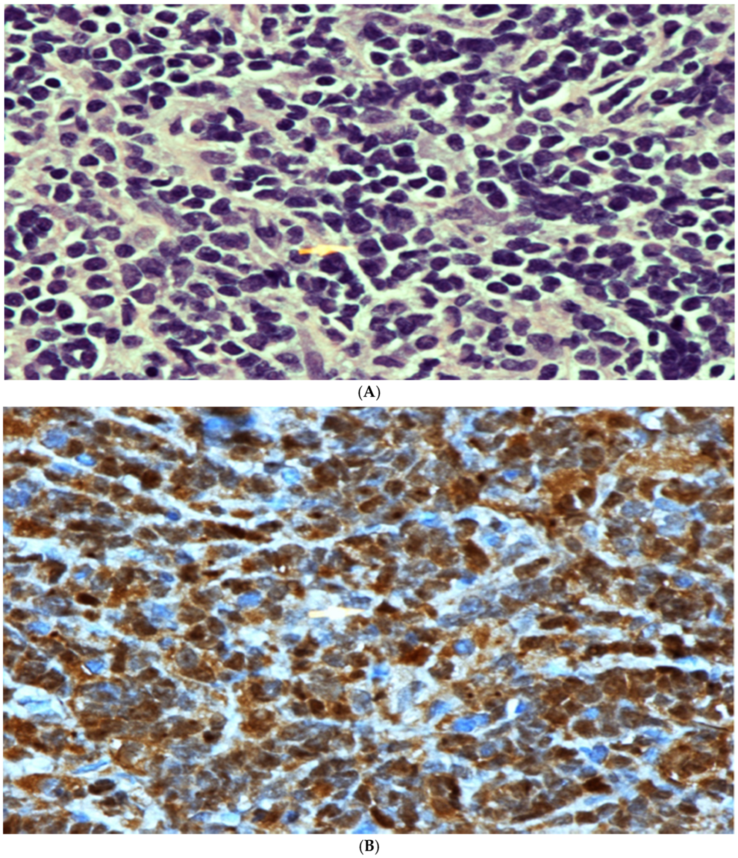 Hematolrep 16 00069 g002a Hematolrep 16 00069 g002a