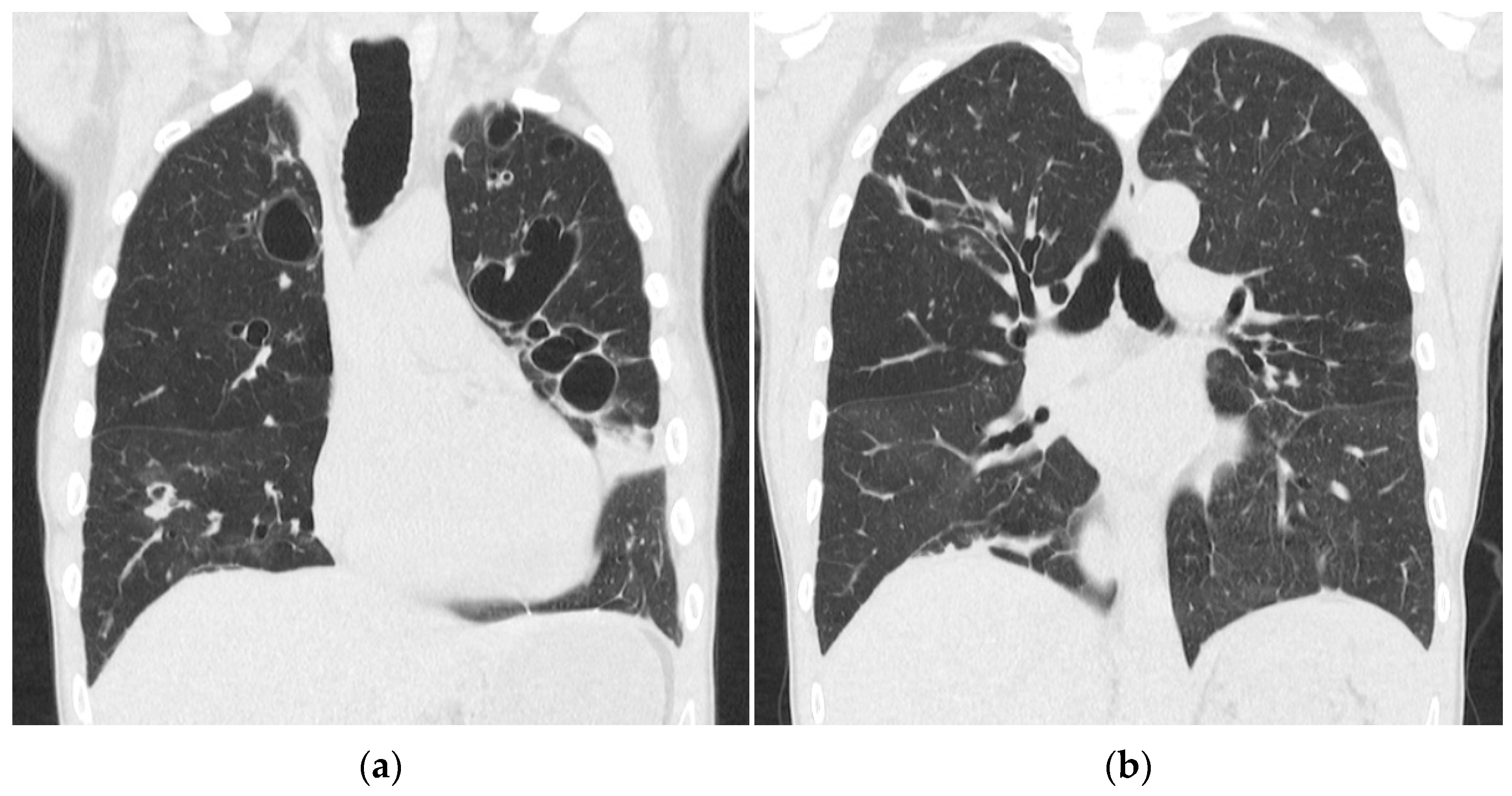 necrotizing pneumonia radiology
