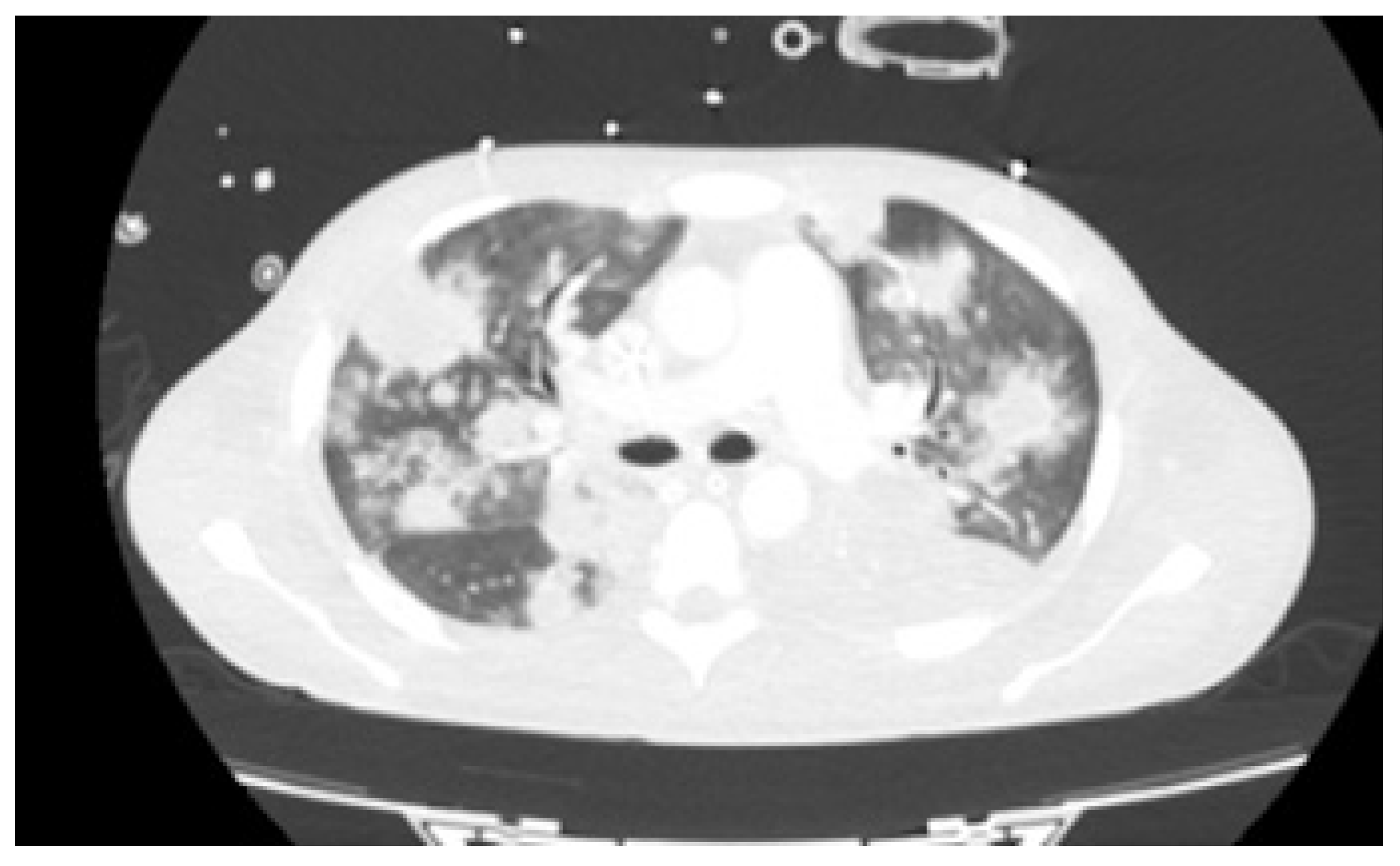 Novel severe oculocutaneous manifestations of human monkeypox virus  infection and their historical analogues - The Lancet Infectious Diseases