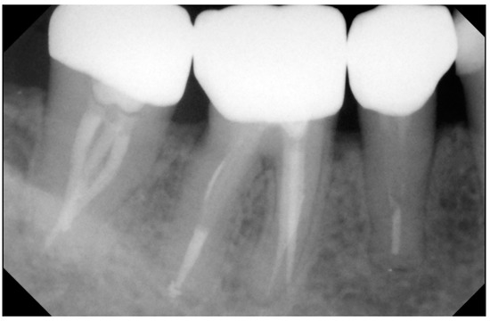 IJERPH | Free Full-Text | Clinical Outcomes of Monolithic Zirconia Crowns  with CAD/CAM Technology. A 1-Year Follow-Up Prospective Clinical Study of  65 Patients | HTML