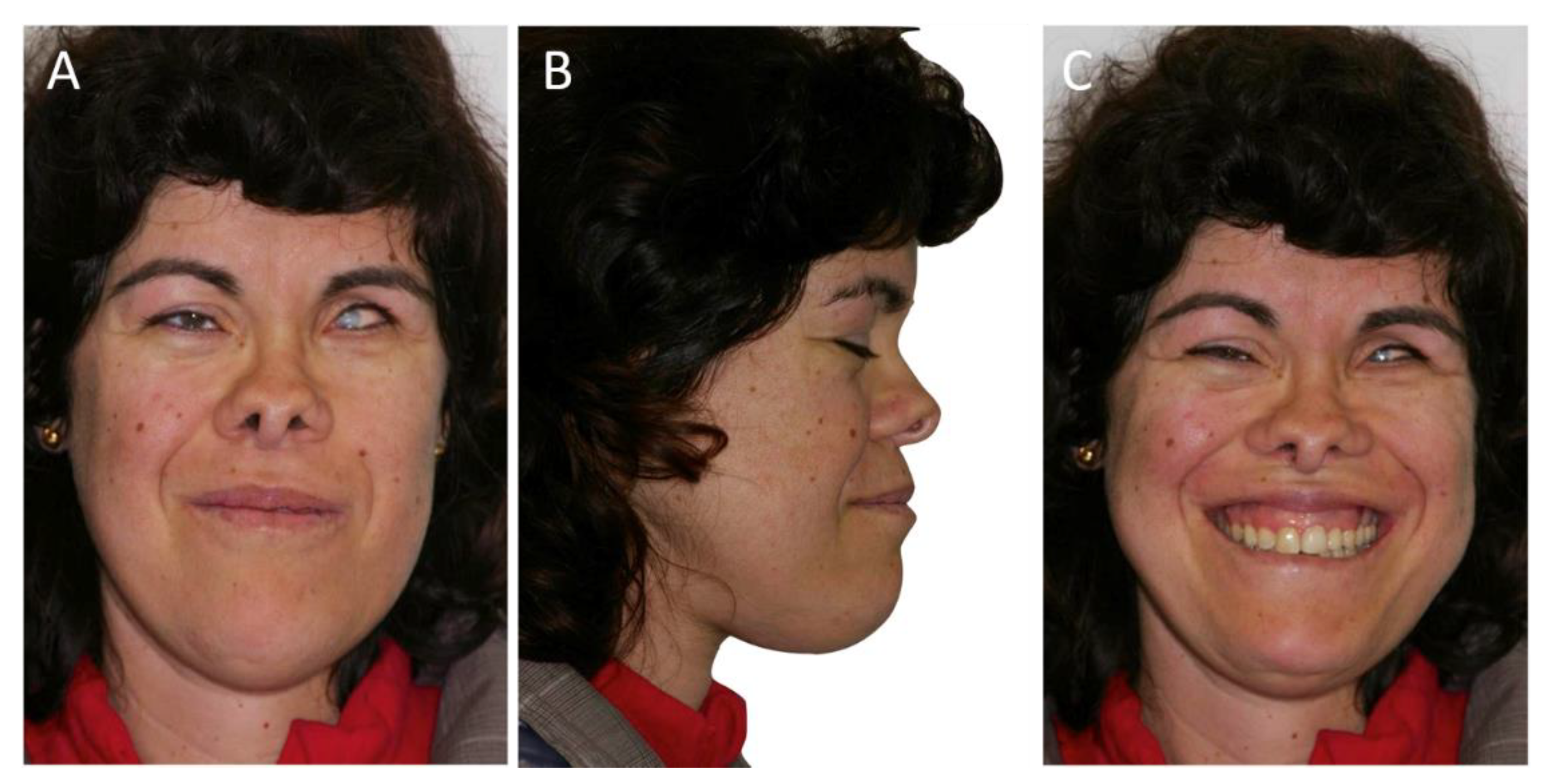 IJERPH | Free Full-Text | Oculo-Facio-Cardio-Dental Syndrome: A Case ...