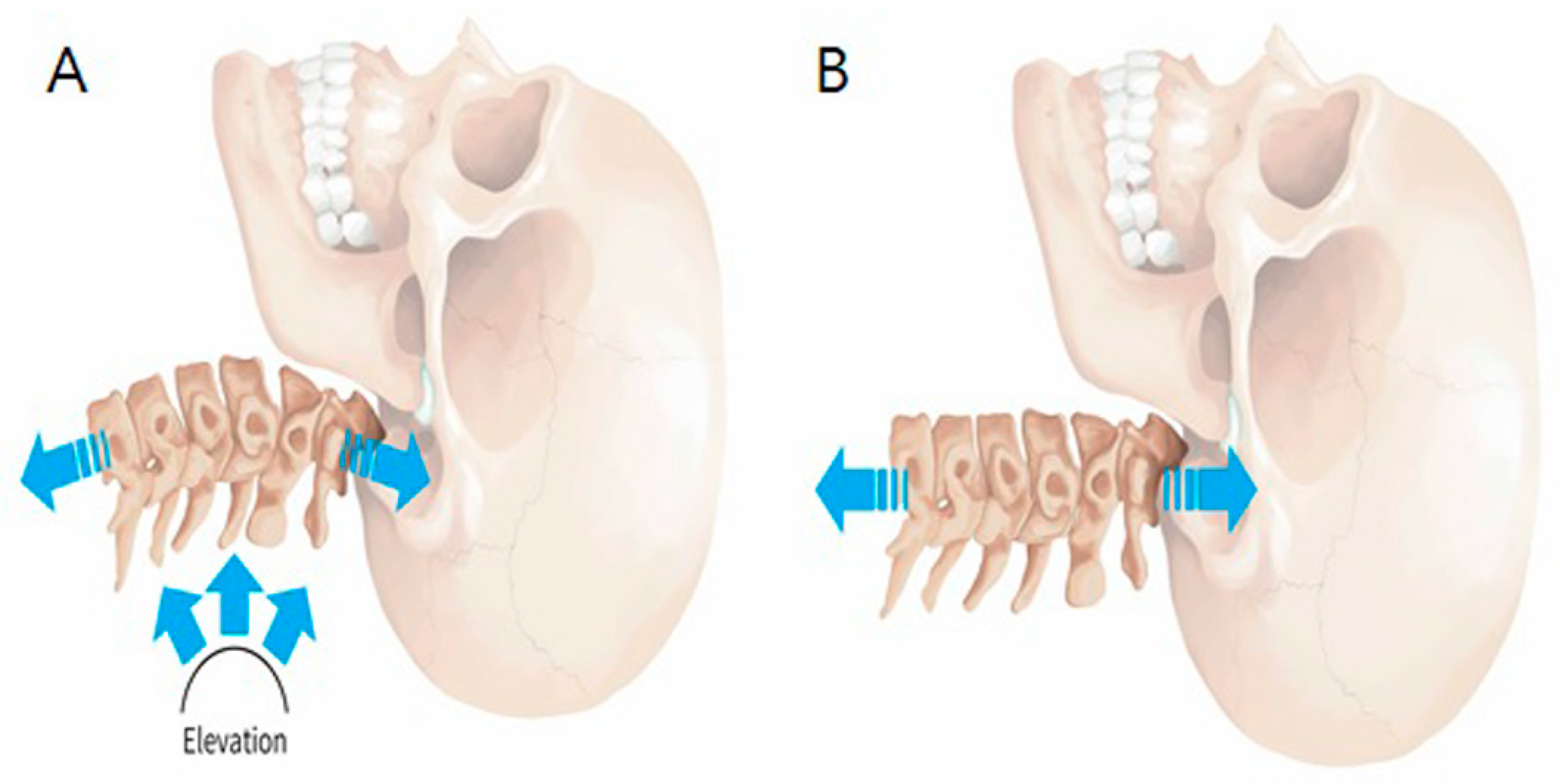 Anterior and Vertical Translations of the Cervical Spine Increase Stresses  up to 4.25 Times; Likely Accelerating the Development of Spinal Arthritis  and Disc Disease – Chiropractic BioPhysics NonProfit