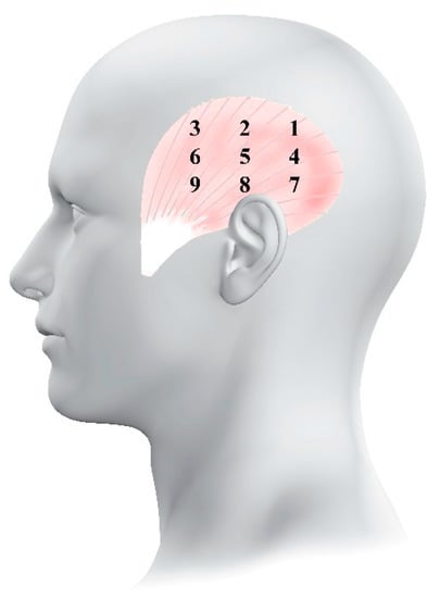 Ijerph Free Full Text Spatial Distribution Of Temporalis Pressure Pain Sensitivity In Men With Episodic Cluster Headache Html