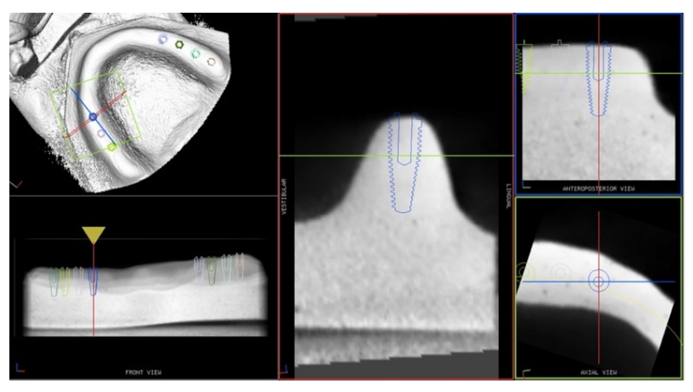 IJERPH | Free Full-Text | Dynamic Navigation in Dental Implantology: The  Influence of Surgical Experience on Implant Placement Accuracy and  Operating Time. An in Vitro Study