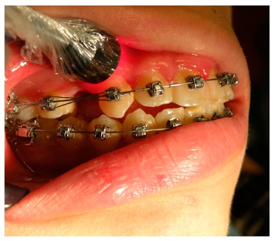 IJERPH | Free Full-Text | Photobiomodulation Therapy on Orthodontic  Movement: Analysis of Preliminary Studies with a New Protocol