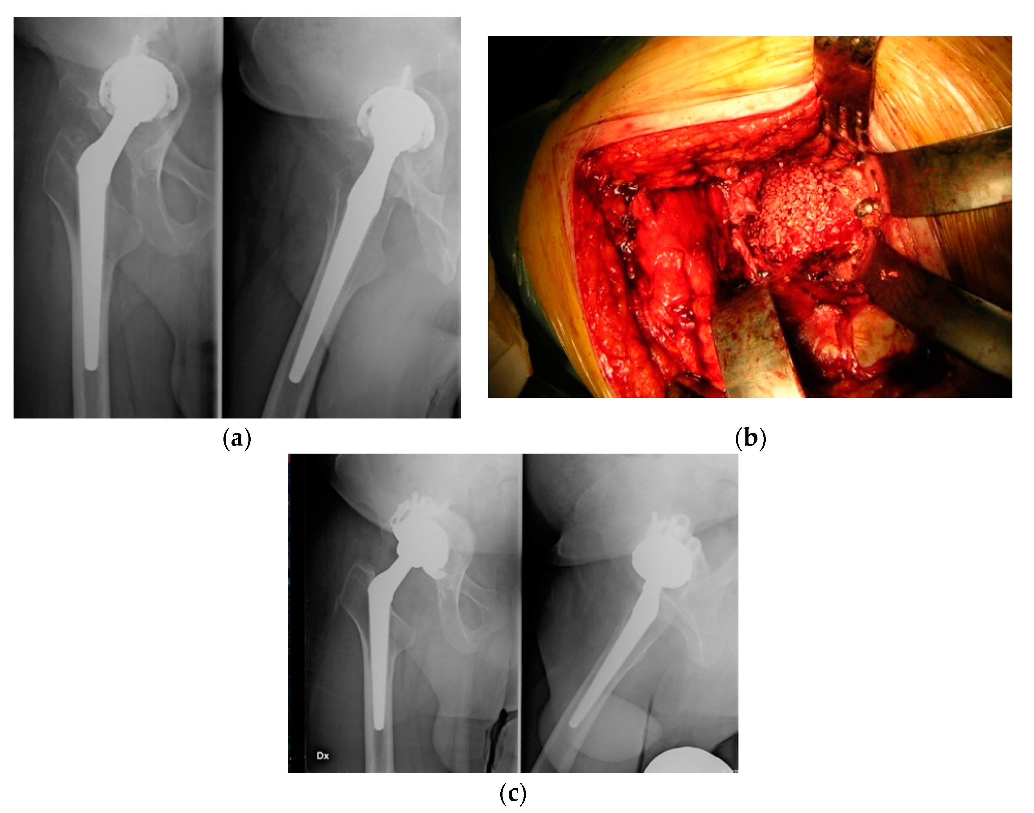 Frontiers  Well-Placed Acetabular Component Oriented Outside the Safe Zone  During Weight-Bearing Daily Activities