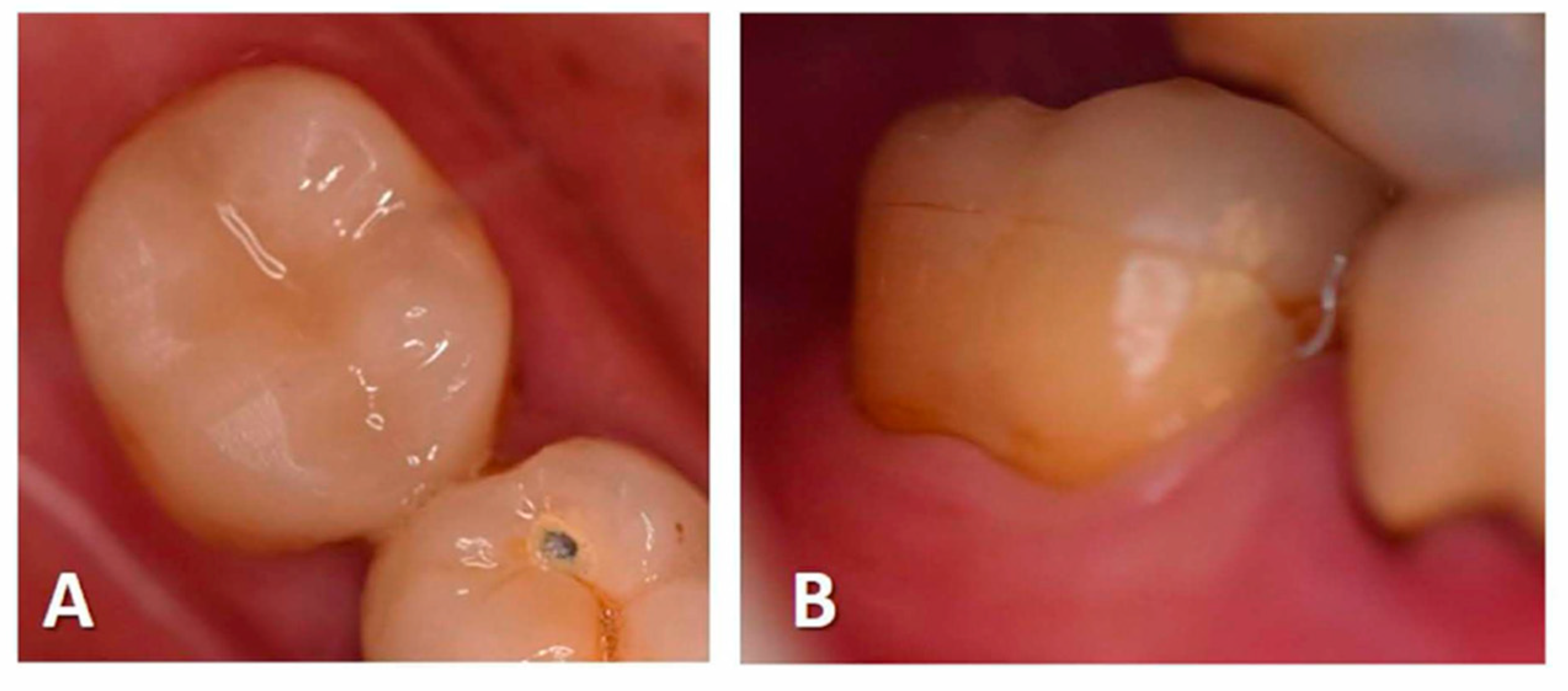 Ijerph Free Full Text A Combination Of Full Pulpotomy And Chairside Cad Cam Endocrown To Treat Teeth With Deep Carious Lesions And Pulpitis In A Single Session A Preliminary Study Html