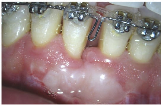 Ijerph Free Full Text Improvement Of Periodontal Parameters With The Sole Use Of Free Gingival Grafts In Orthodontic Patients Correlation With Periodontal Indices A 15 Month Clinical Study Html