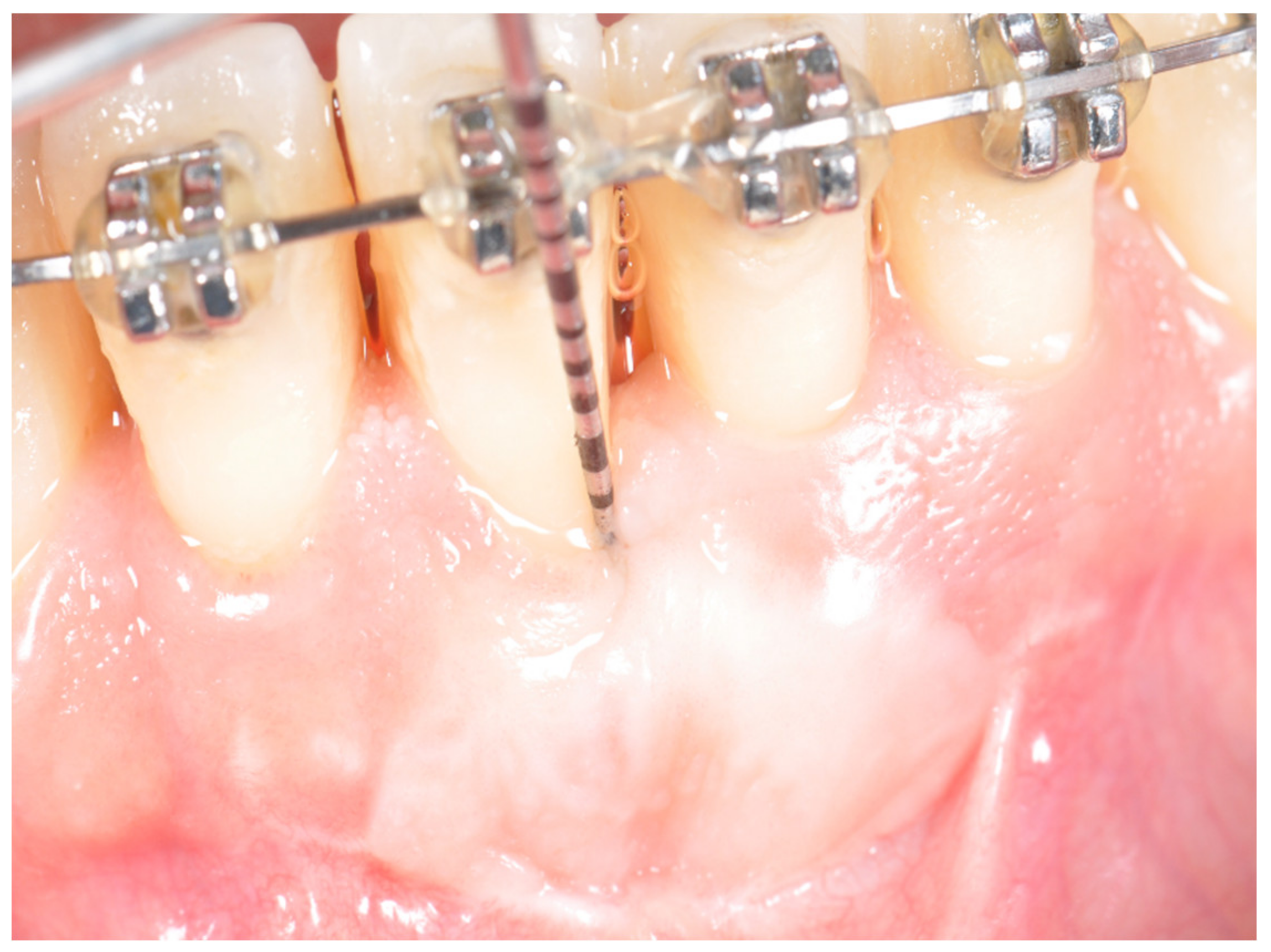 Ijerph Free Full Text Improvement Of Periodontal Parameters With The Sole Use Of Free Gingival Grafts In Orthodontic Patients Correlation With Periodontal Indices A 15 Month Clinical Study Html