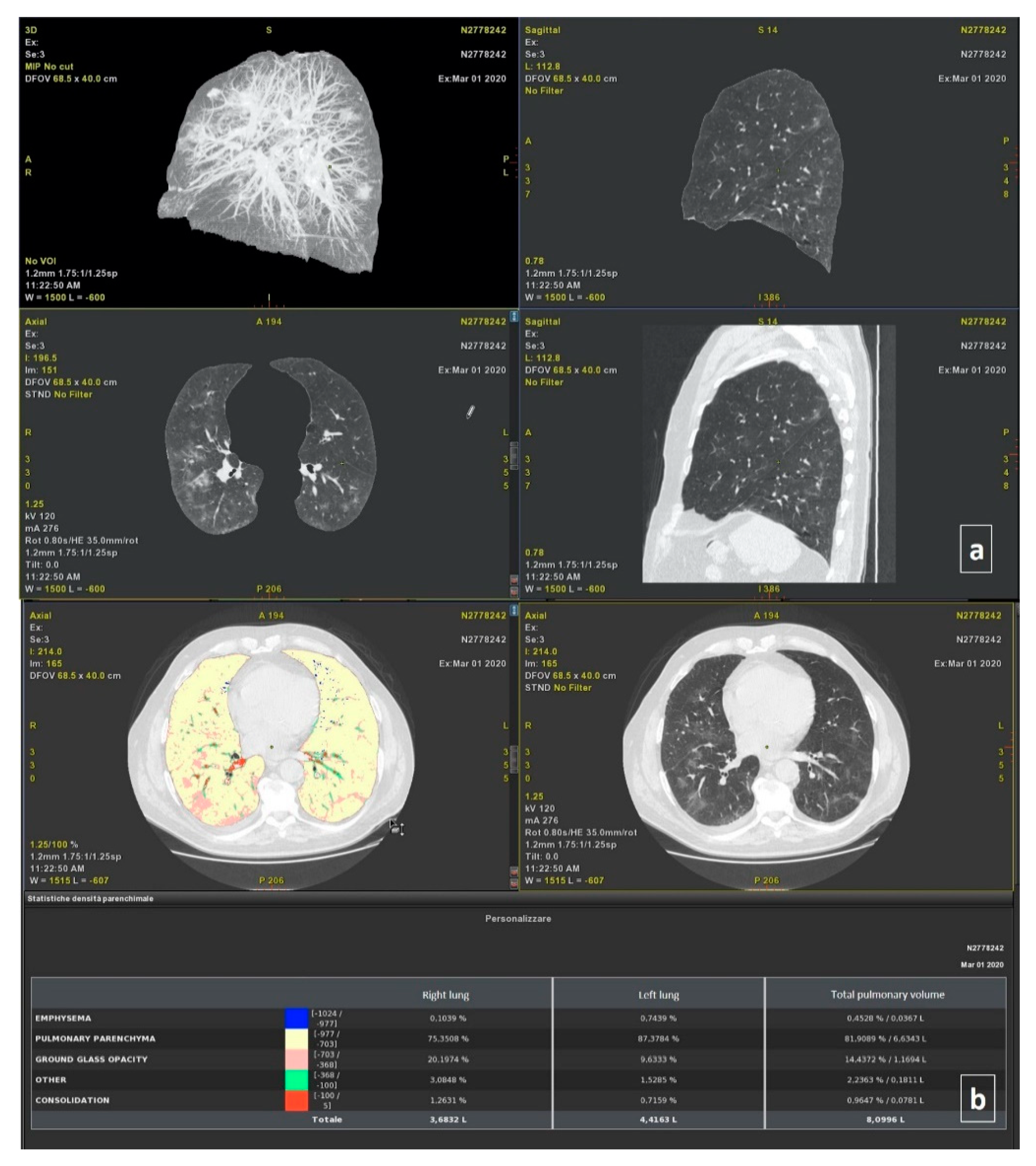 A chest CT report sample annotated with BIO tags a Original CT