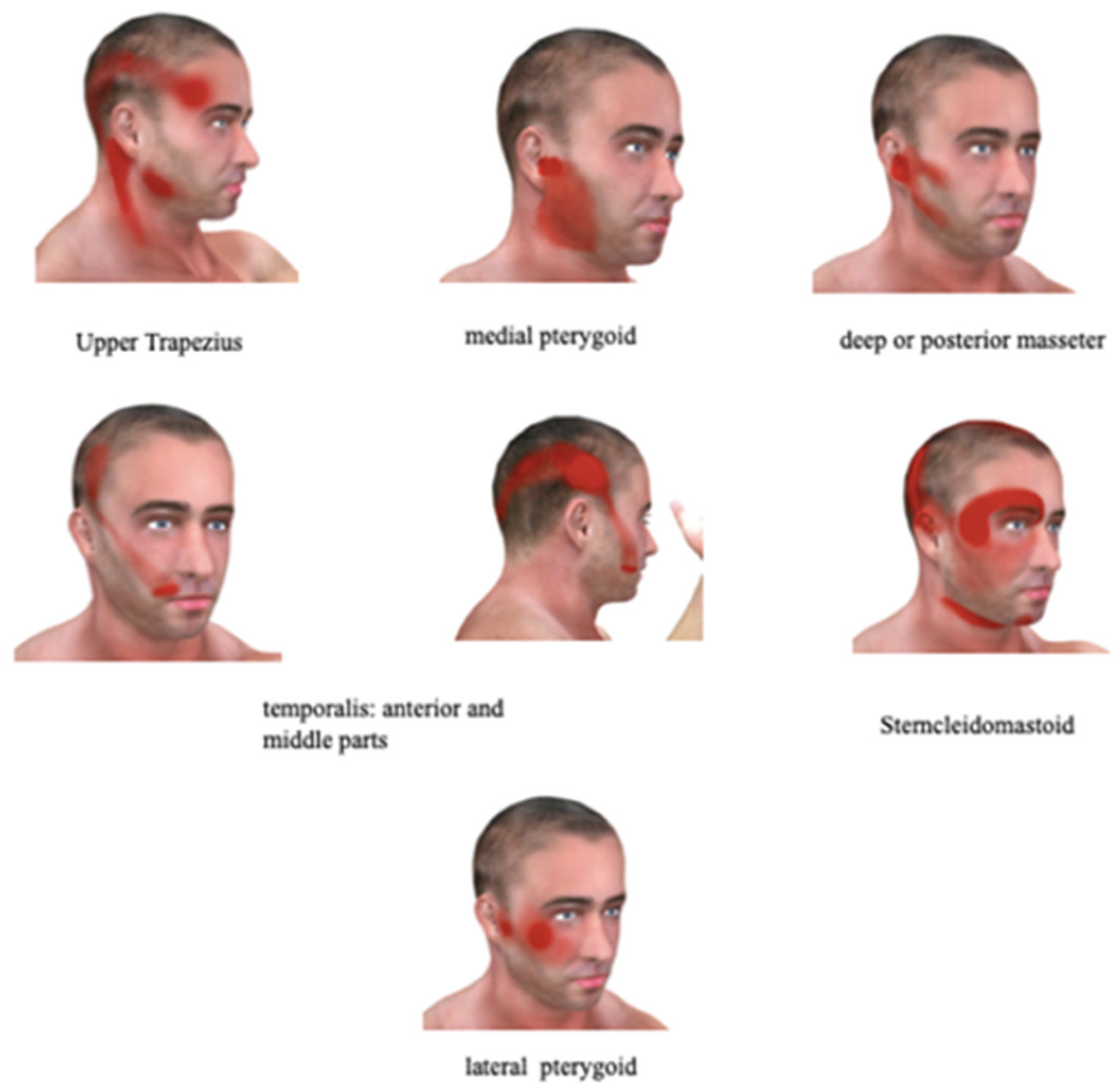 IJERPH | Free Full-Text | Chronic Facial Pain: Trigeminal Neuralgia,  Persistent Idiopathic Facial Pain, and Myofascial Pain Syndrome—An  Evidence-Based Narrative Review and Etiological Hypothesis