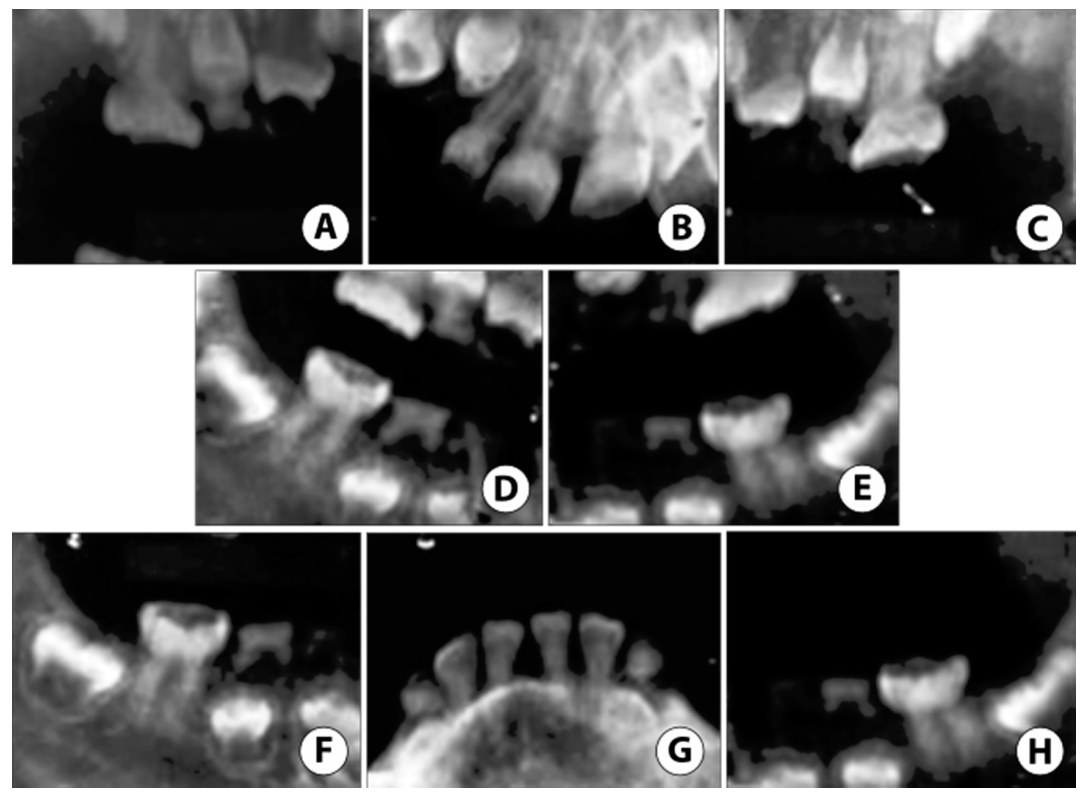 IJERPH | Free Full-Text | Full Mouth Rehabilitation of Two Siblings with  Dentinogenesis Imperfecta Type II Using Different Treatment Modalities |  HTML