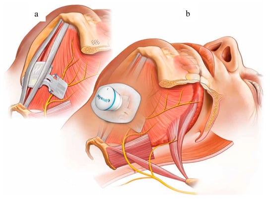 Types of Sleep Apnea Treatment (Include Inspire Upper Airway Stimulation  therapy) » Head & Neck Surgical Associates