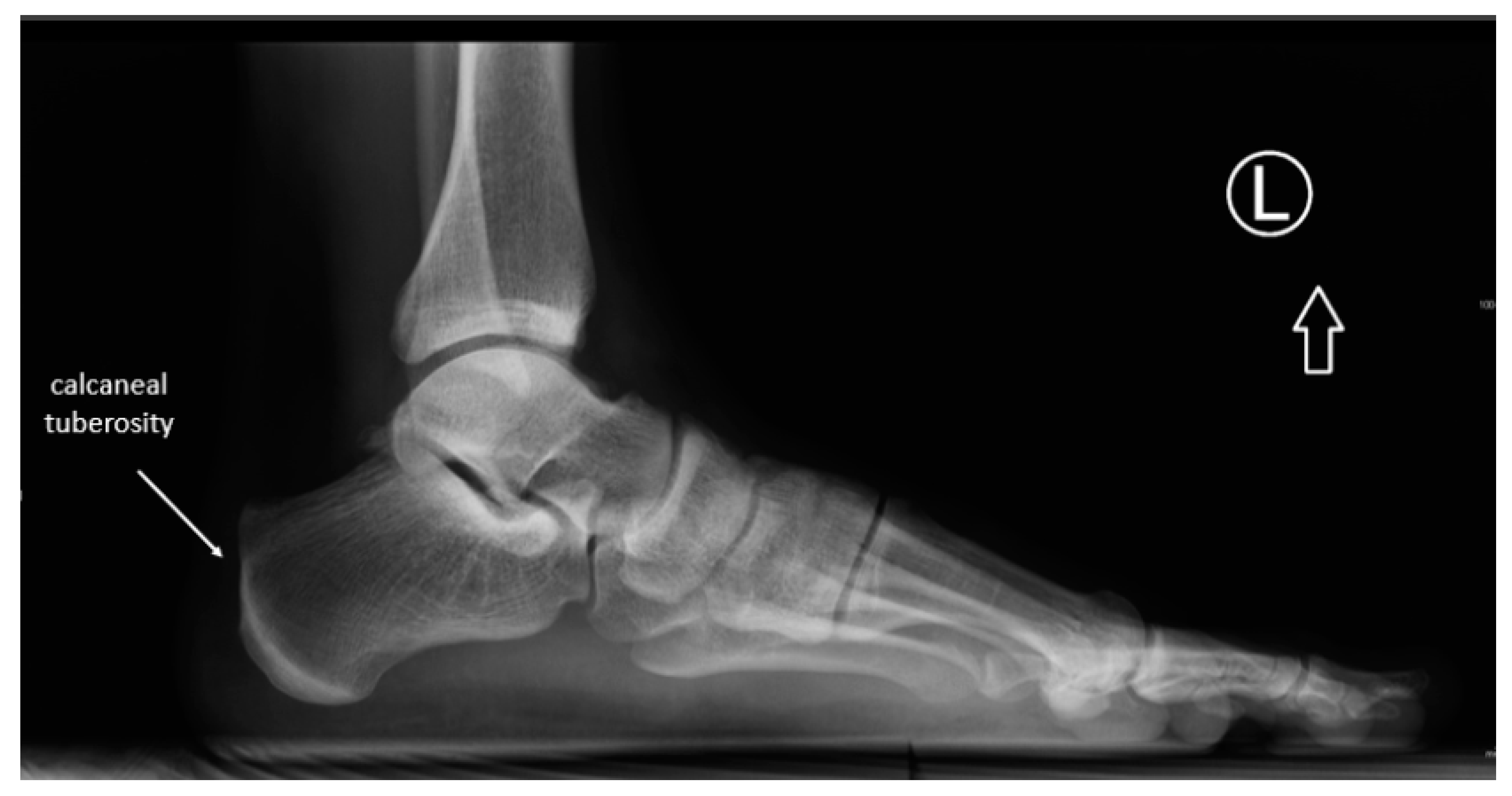 Retrocalcaneal Bursa Erosive Disease Radiology