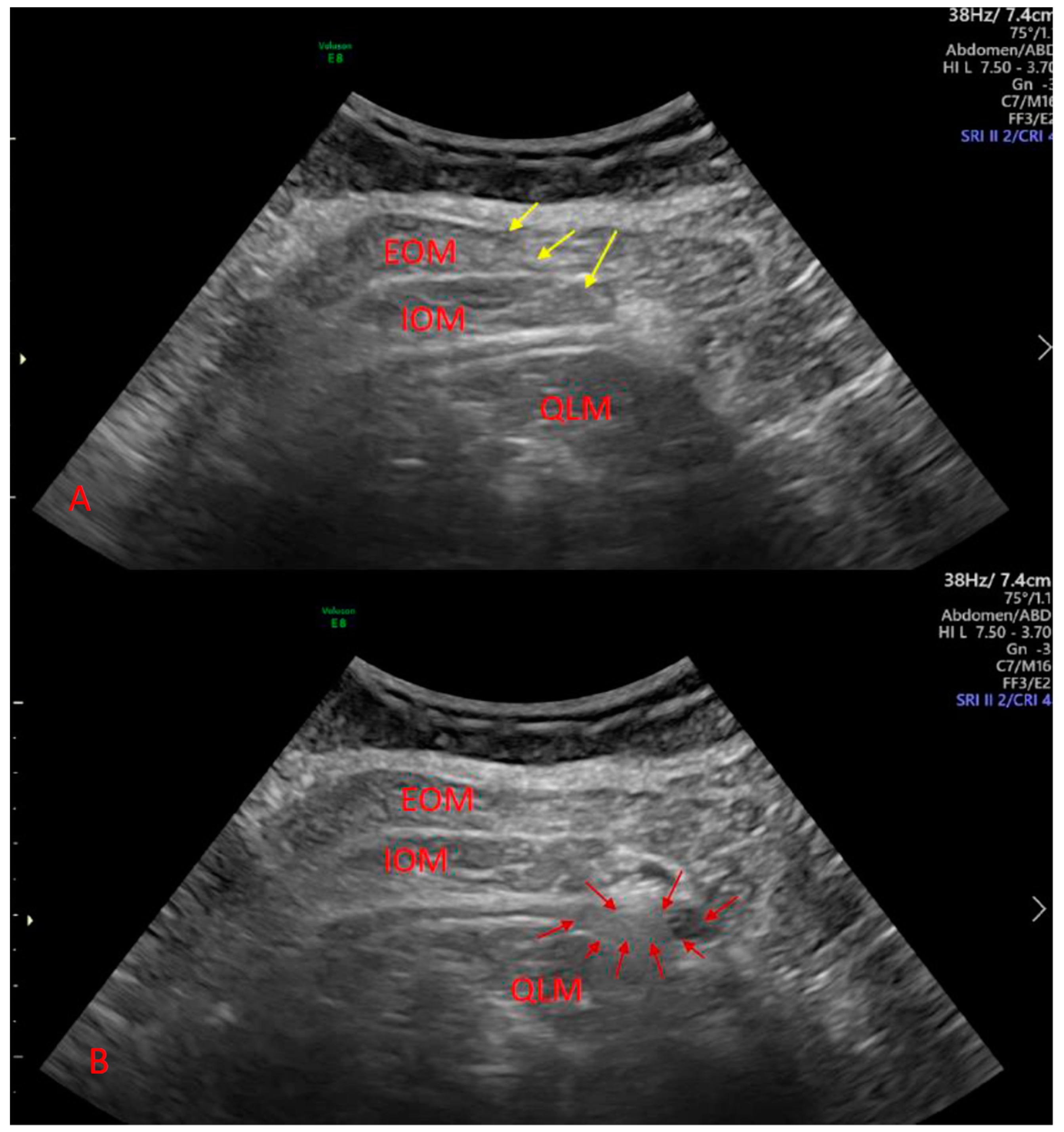 Frontiers  Ultrasound-guided transversus abdominis plane block as