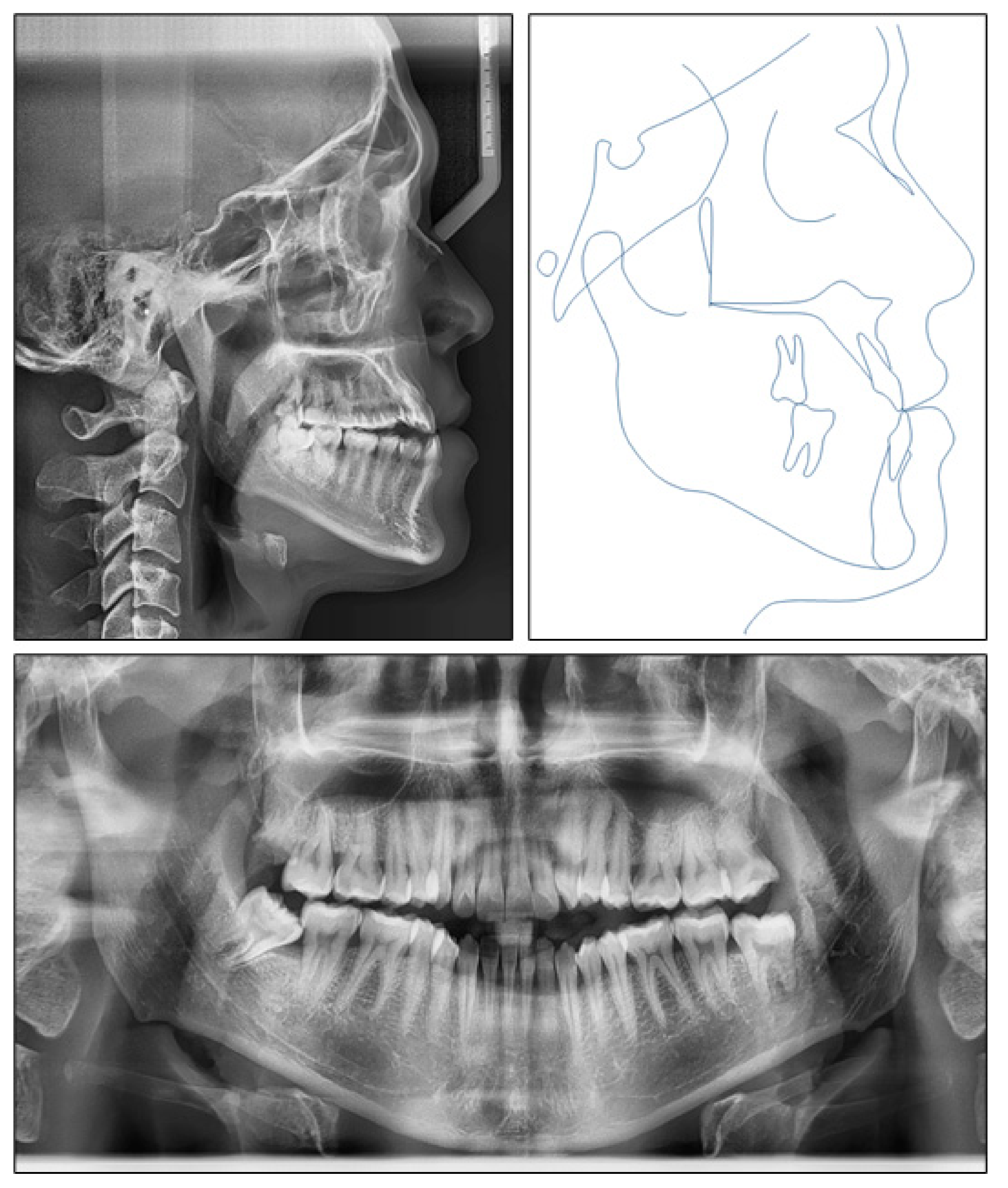 x ray open bite