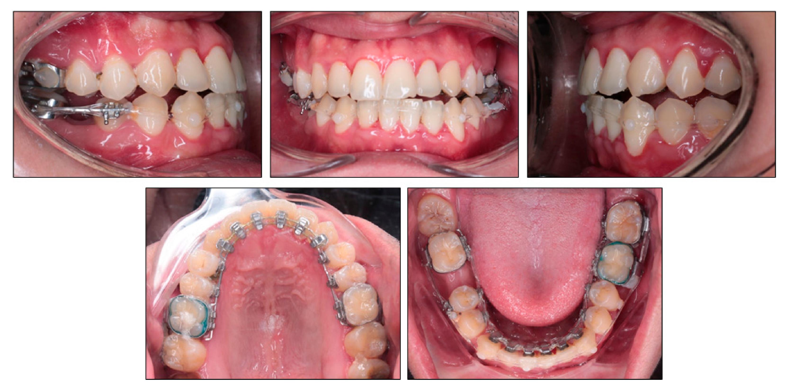 What is a class I, class II or class III bite? - Instituto Maxilofacial