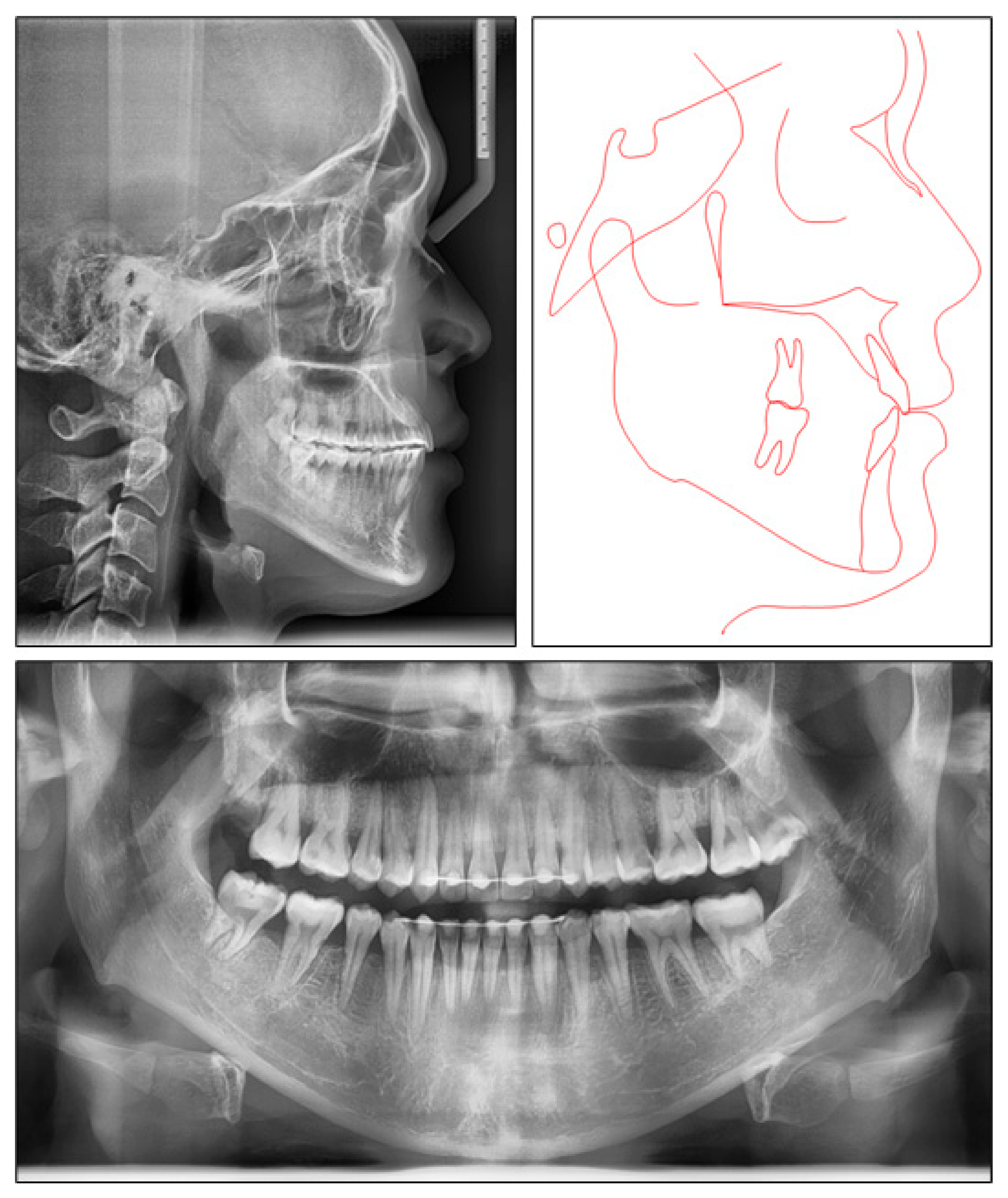 x ray open bite