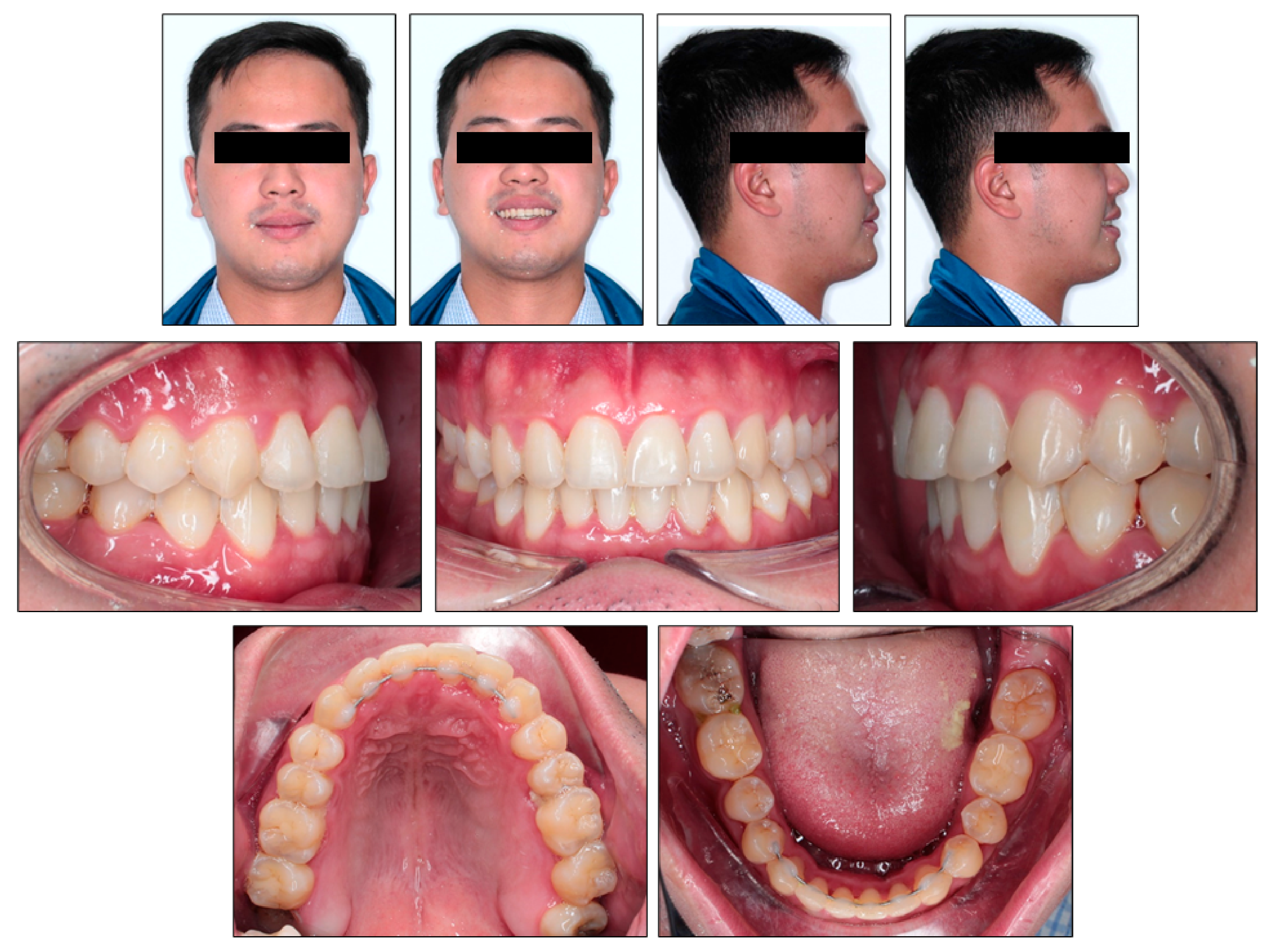 Orthodontics: Maloccclusion, other problems, and starting treatment