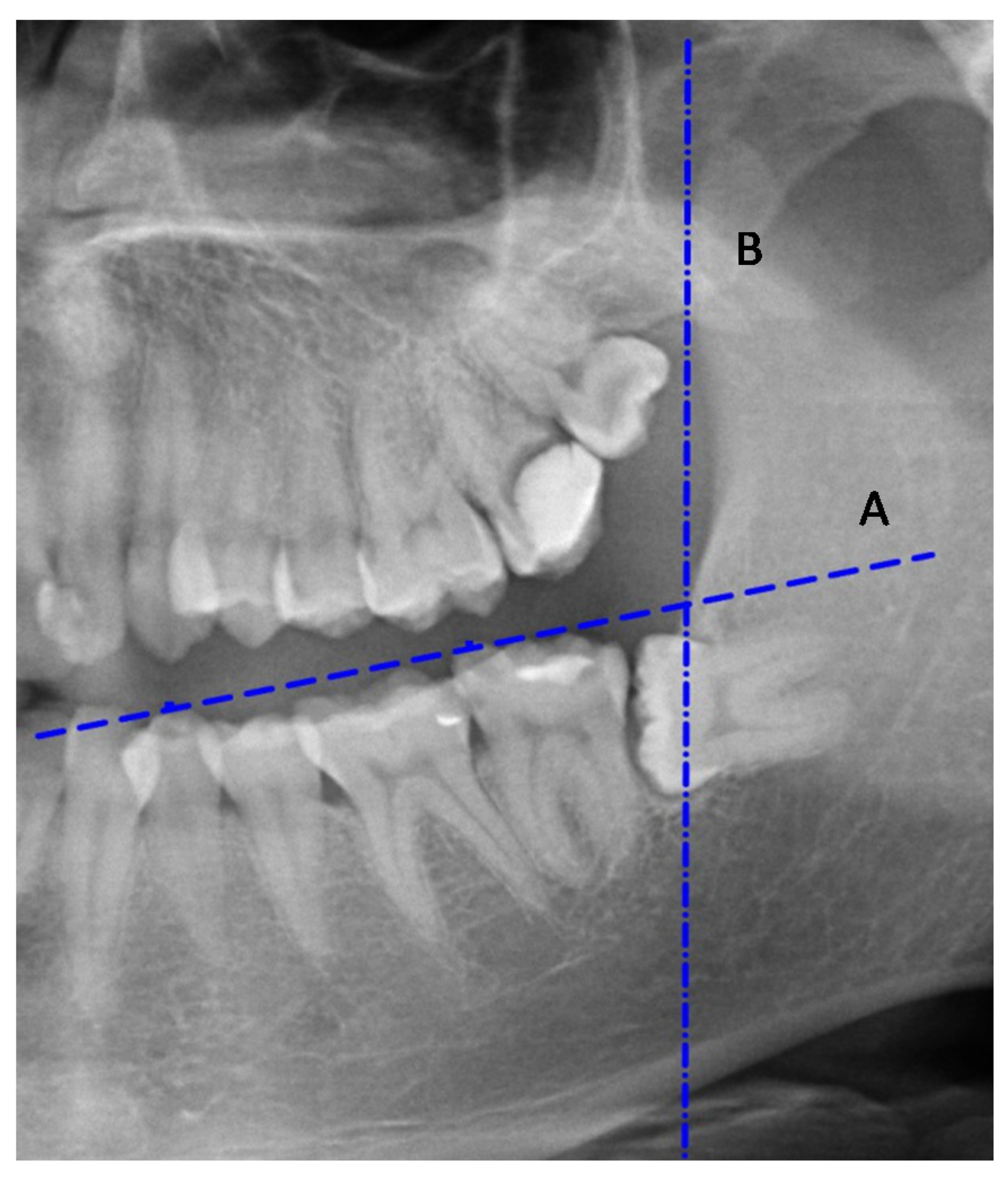 Ijerph Free Full Text The Pattern Of Mandibular Third Molar Impaction And Assessment Of Surgery Difficulty A Retrospective Study Of Radiographs In East Baltic Population Html