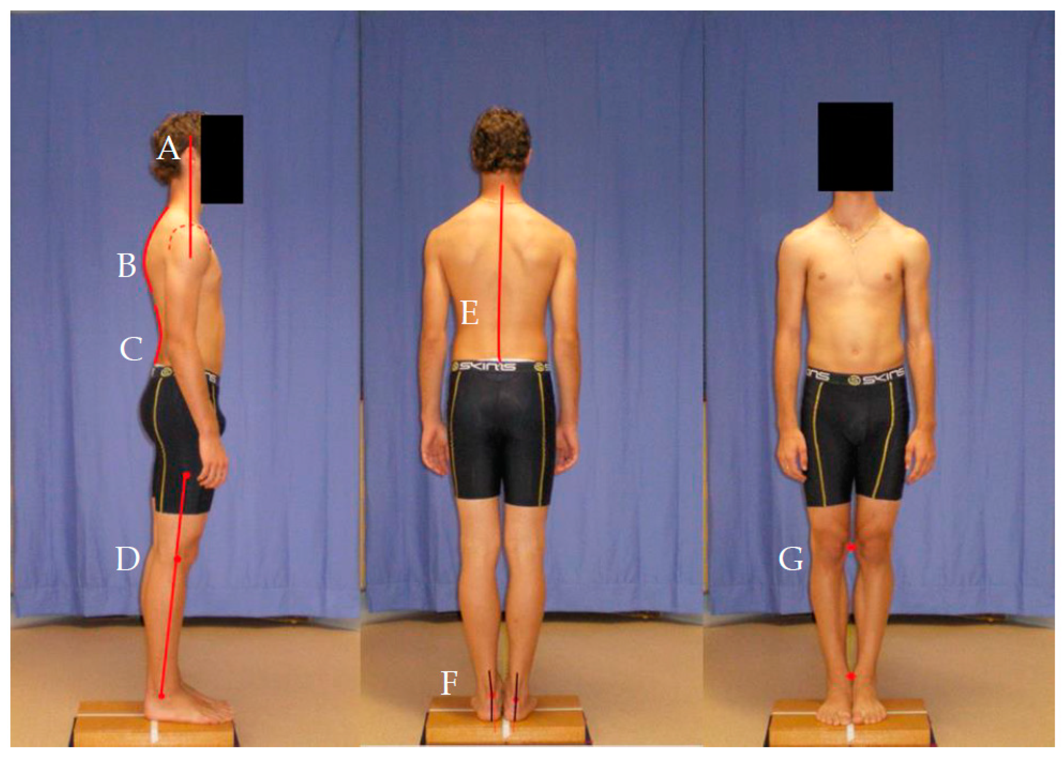 IJERPH Free Full-Text Relationship between Posture and Non-Contact Lower Limb Injury in Young Male Amateur Football Players A Prospective Cohort Study image pic