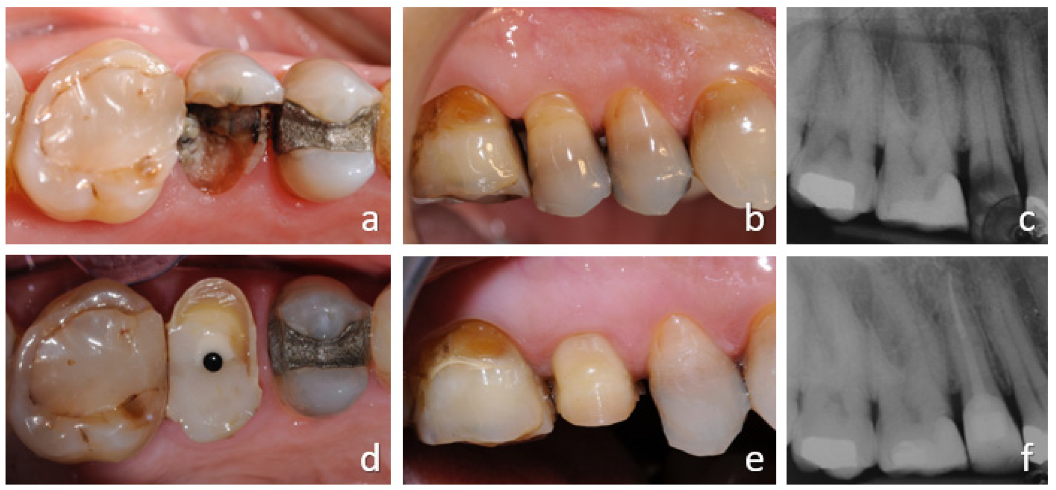 IJERPH | Free Full-Text | Orthodontic Extrusion vs. Surgical Extrusion to  Rehabilitate Severely Damaged Teeth: A Literature Review