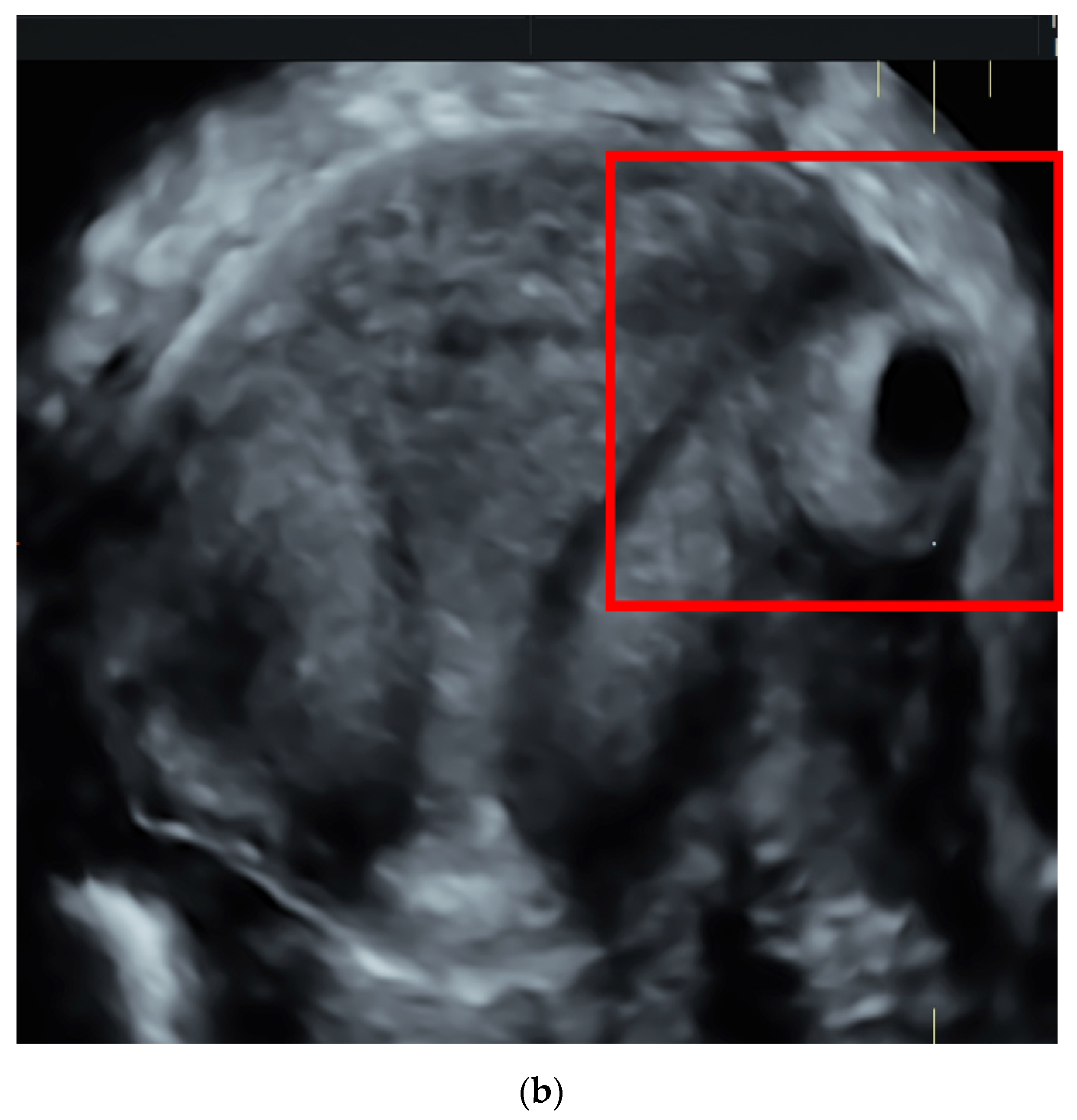 Ijerph Free Full Text Interstitial Ectopic Pregnancy The Role Of