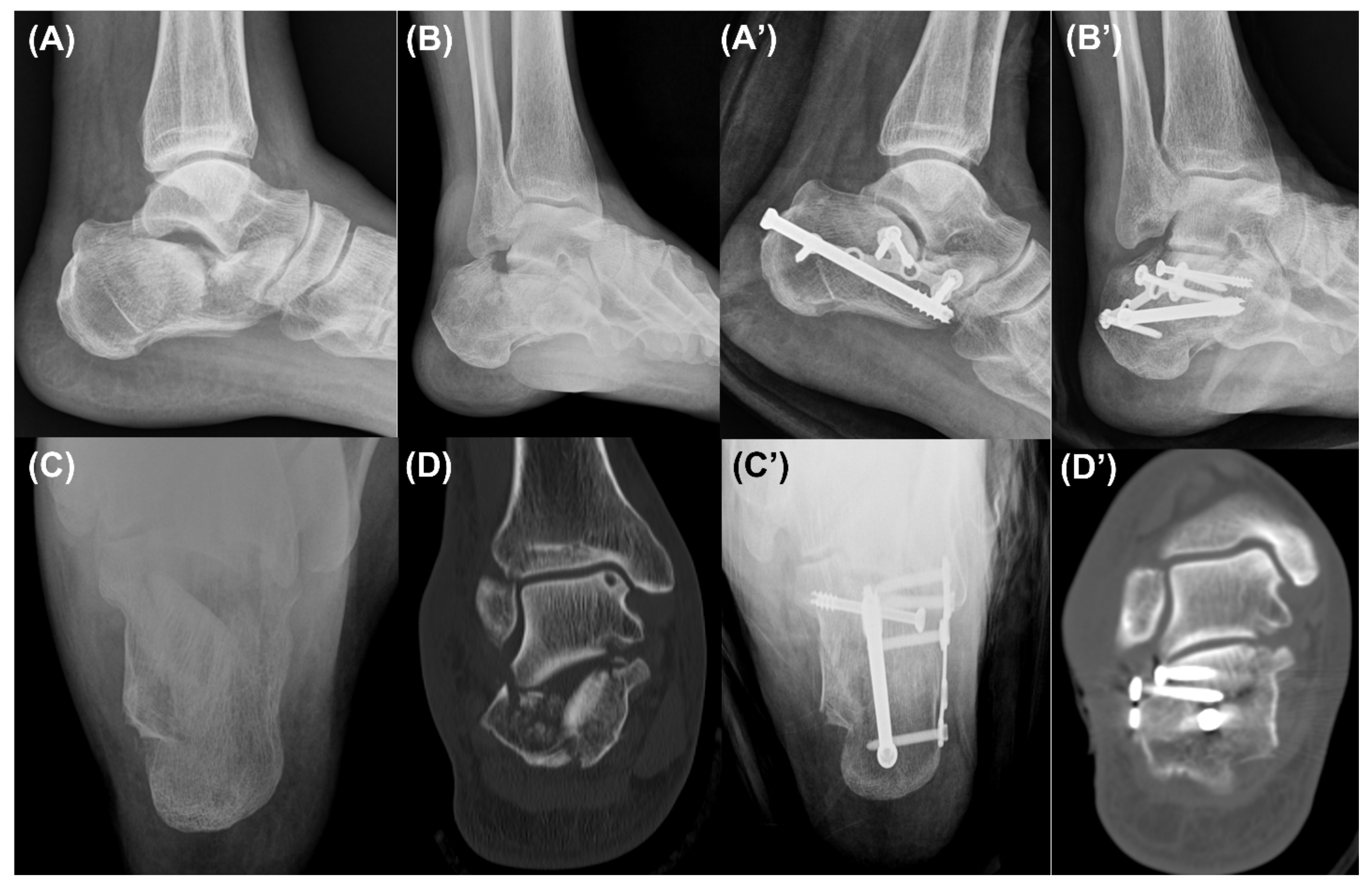 life after a calcaneus fracture surgery