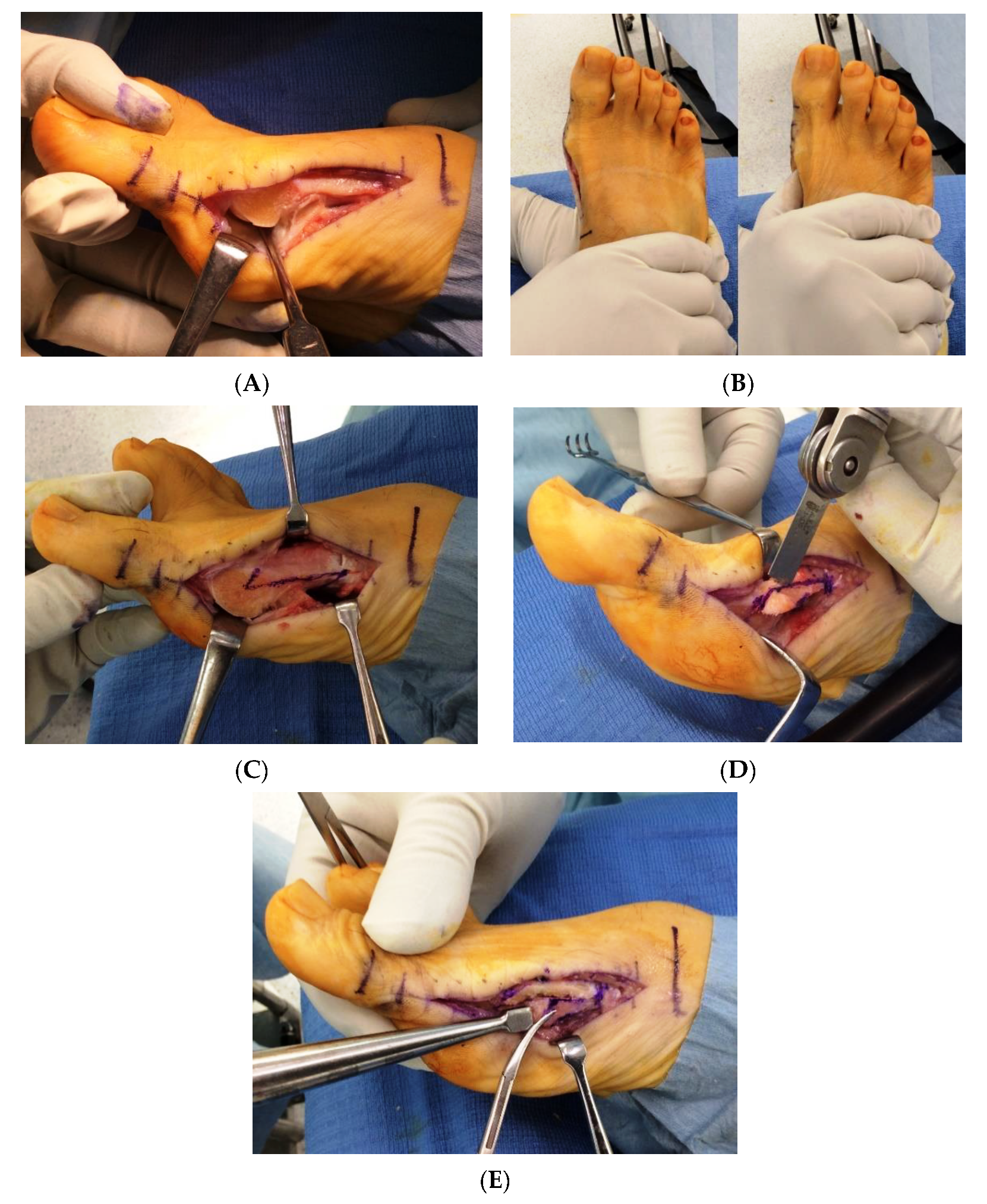 IJERPH | Free Full-Text | Outcomes of Scarf and Akin Osteotomy with  Intra-Articular Stepwise Lateral Soft Tissue Release for Correcting Hallux  Valgus Deformity in Rheumatoid Arthritis