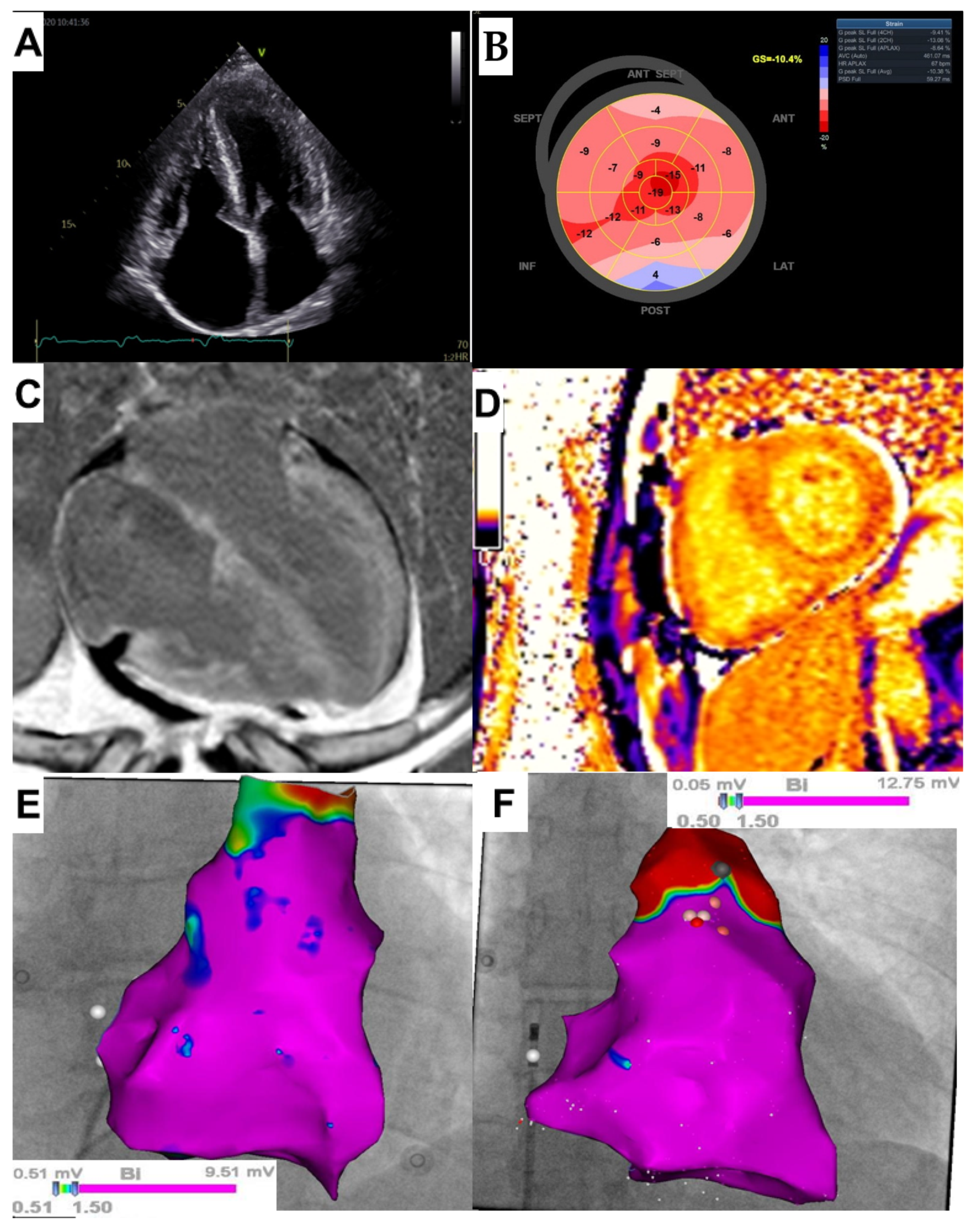 Frontiers  Cardiac Amyloidosis: A Review of Current Imaging Techniques