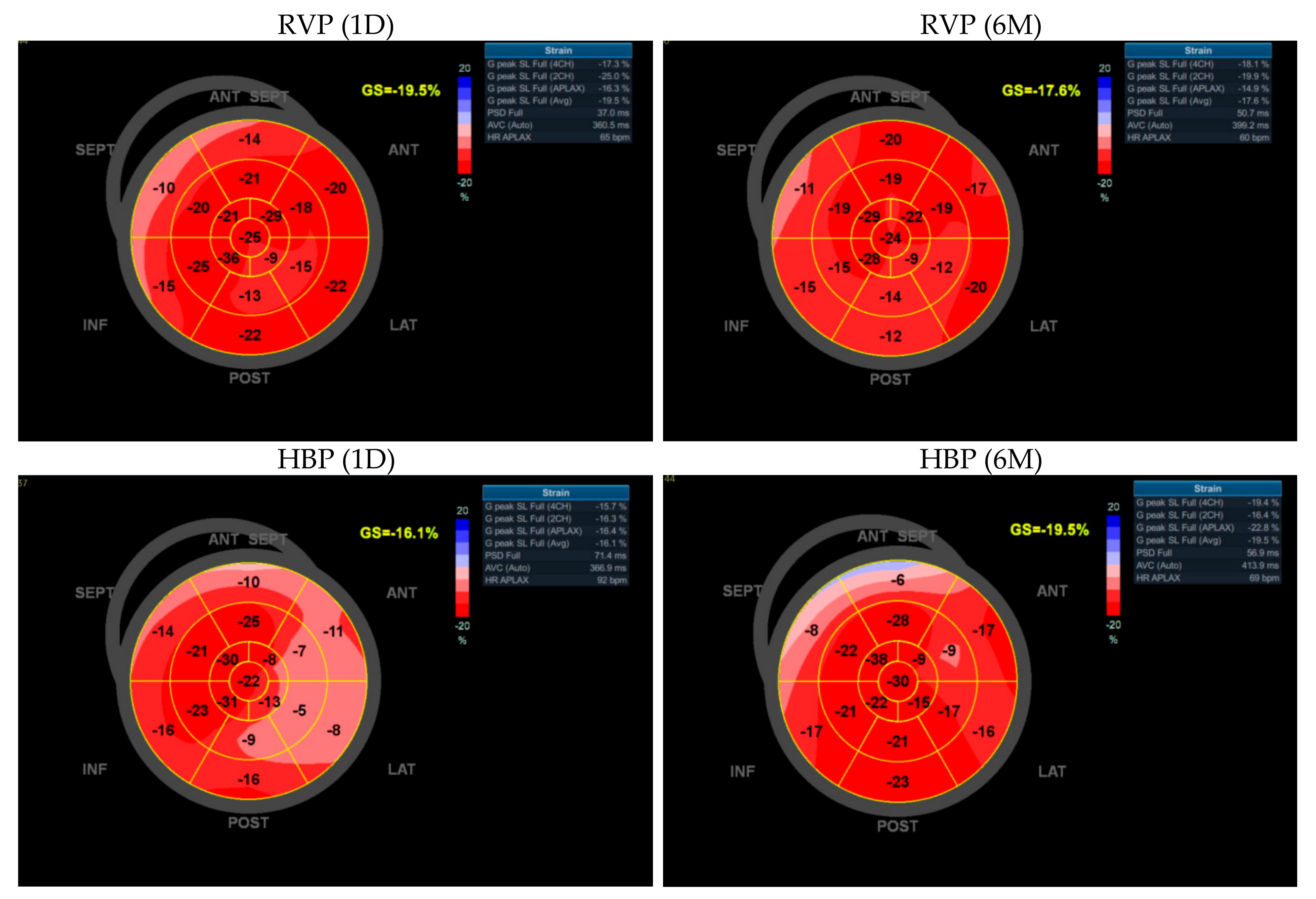 Value of peak strain dispersion in discovering left ventricular dysfunction  in diabetes mellitus