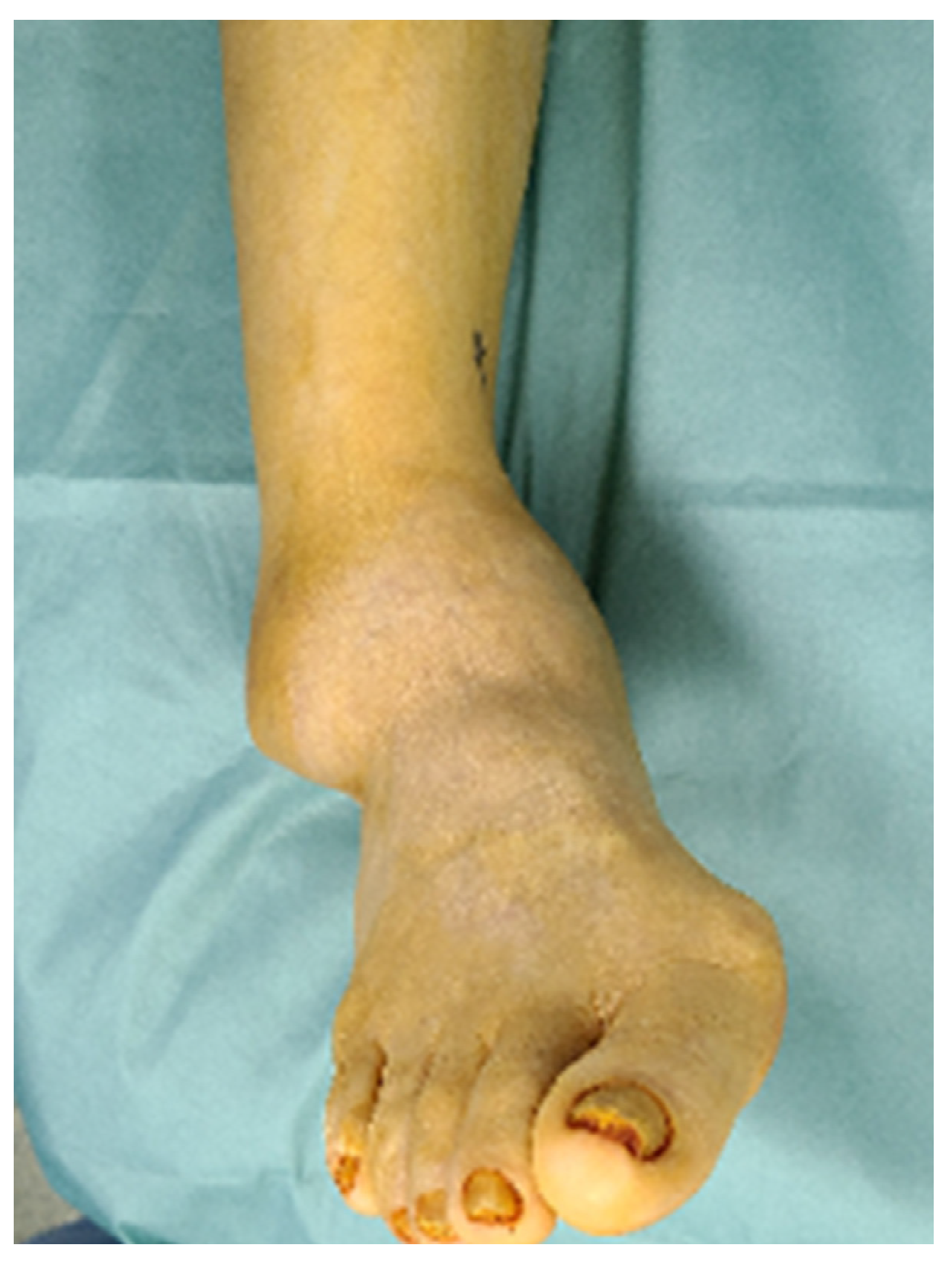 The Second Ankle Joint - Consulting Footpain