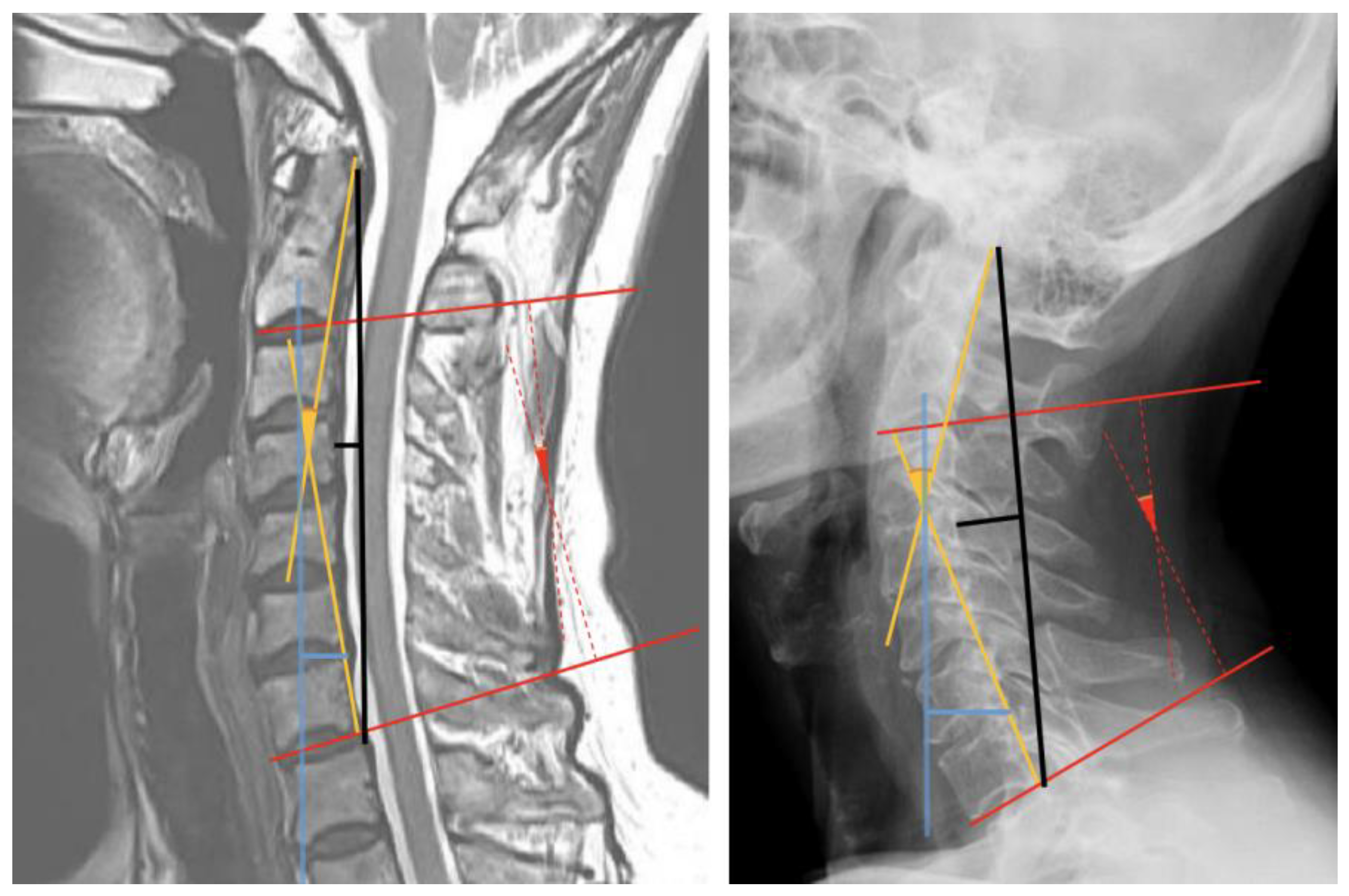 IJERPH | Free Full-Text | Diagnostic Accuracy of Magnetic Resonance Imaging  for Sagittal Cervical Spine Alignment: A Retrospective Cohort Study