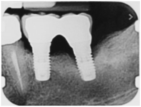 Investigation of the Electric Handpiece-related Pneumomediastinum and  Cervicofacial Subcutaneous Emphysema in Third Molar Surgery