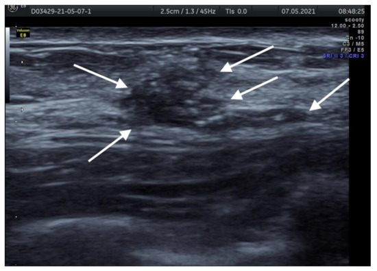 Breast Asymmetry - Radiology