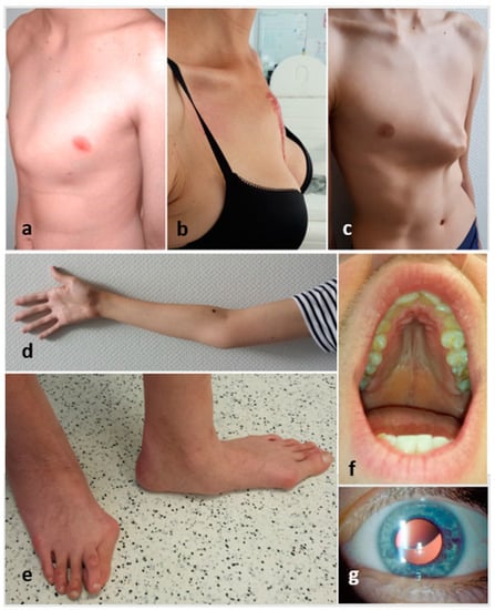 IJERPH | Free Full-Text | How to Distinguish Marfan Syndrome from Marfanoid  Habitus in a Physical Examination&mdash;Comparison of External Features in  Patients with Marfan Syndrome and Marfanoid Habitus