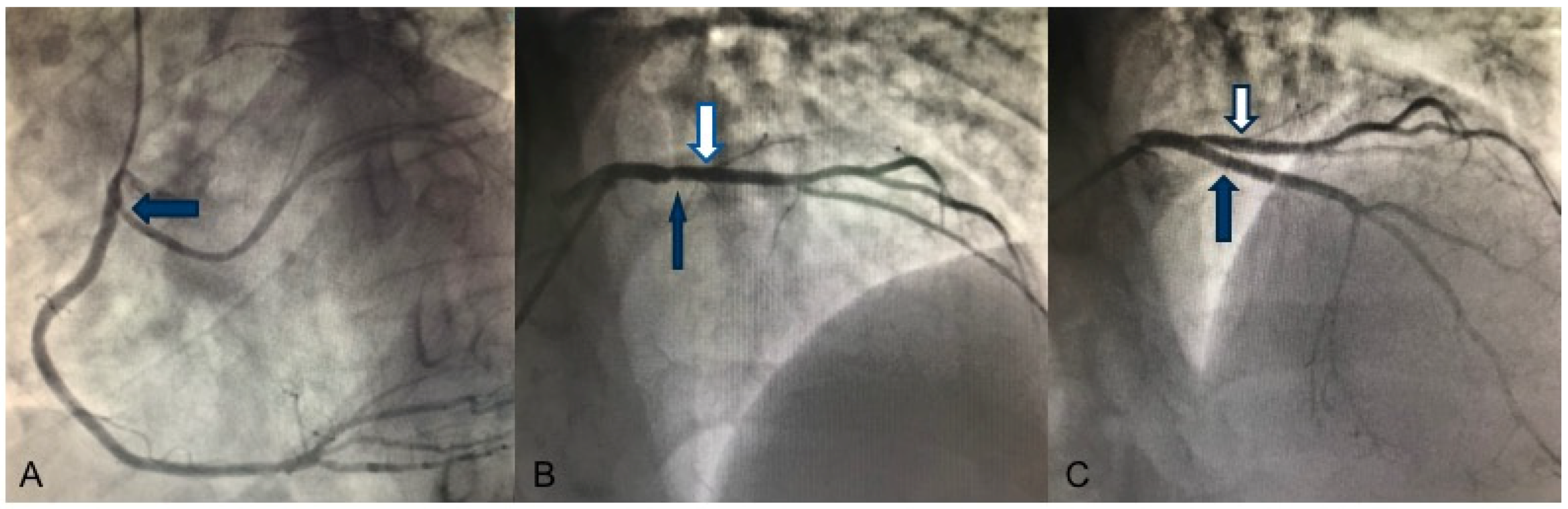 Acute on Chronic Heart Failure Secondary to Left Ventricular Noncompaction