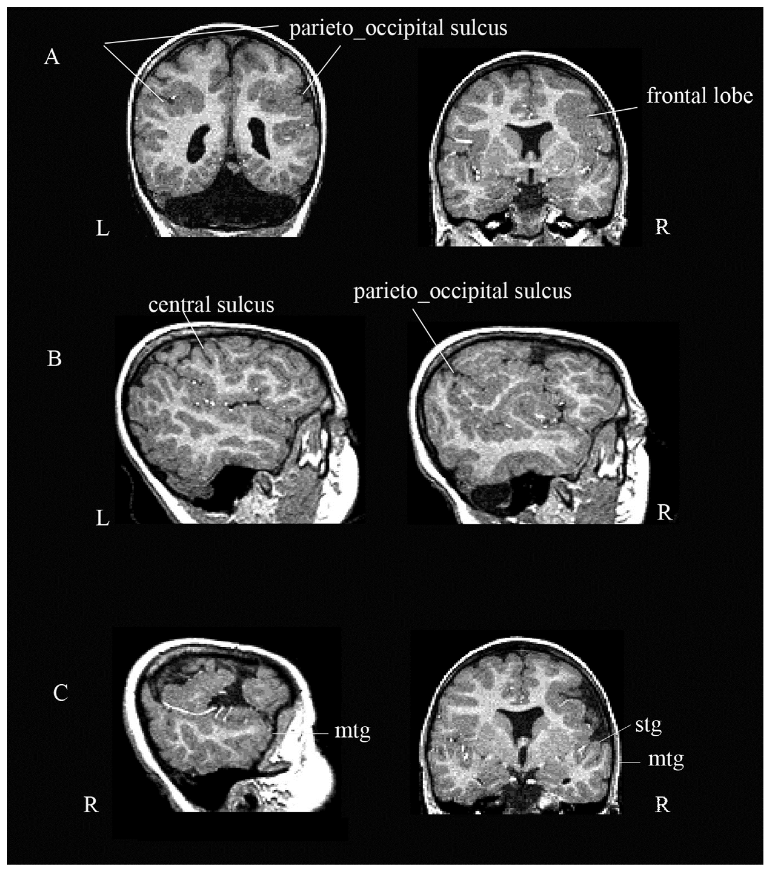 IJERPH | Free Full-Text | Cerebellar Agenesis and Bilateral Polimicrogyria  Associated with Rare Variants of CUB and Sushi Multiple Domains 1 Gene  (CSMD1): A Longitudinal Neuropsychological and Neuroradiological Case Study