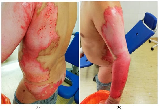 IJERPH | Free Full-Text | Burn Wound Healing: Clinical Complications,  Medical Care, Treatment, and Dressing Types: The Current State of Knowledge  for Clinical Practice